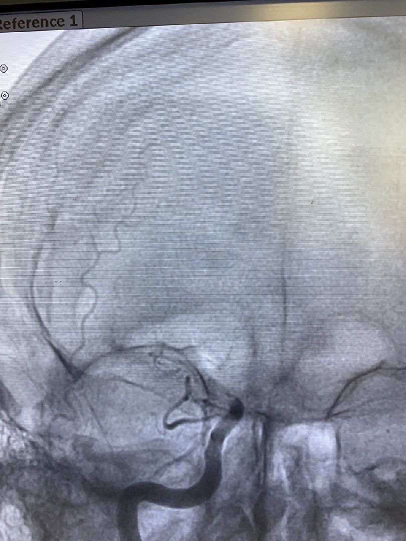 Дмитровская областная больница, Региональный сосудистый центр, Минздрав МО