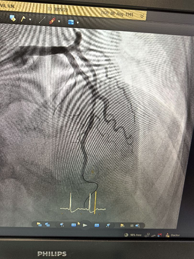 Операция, стентирование, сосудистый центр, ФБУЗ МСЧ №9 ФМБА России, Дубна
