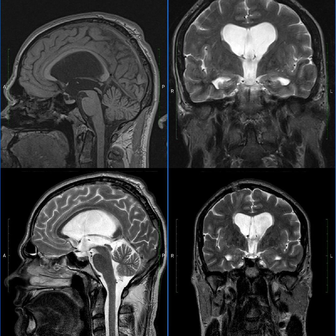 Подольск, медицина, нейрохирург, гидроцефалия
