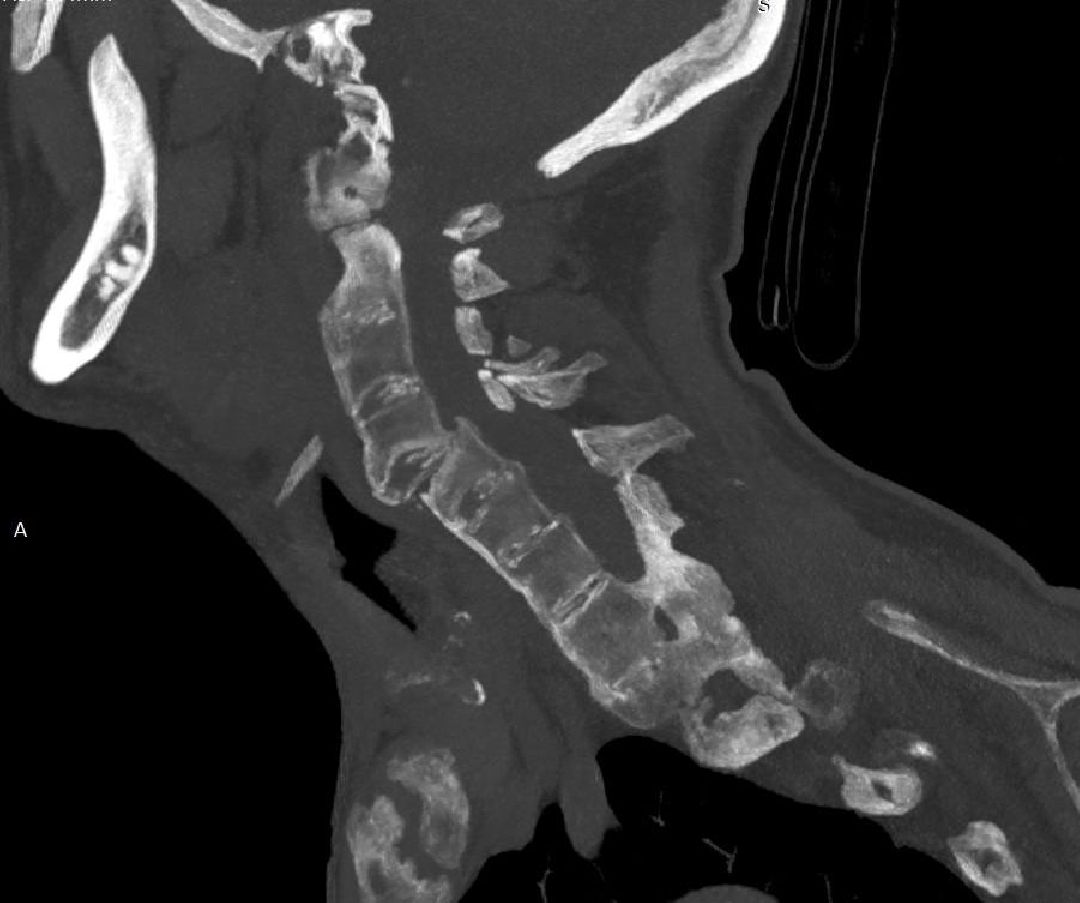 нейрохирурги, операция