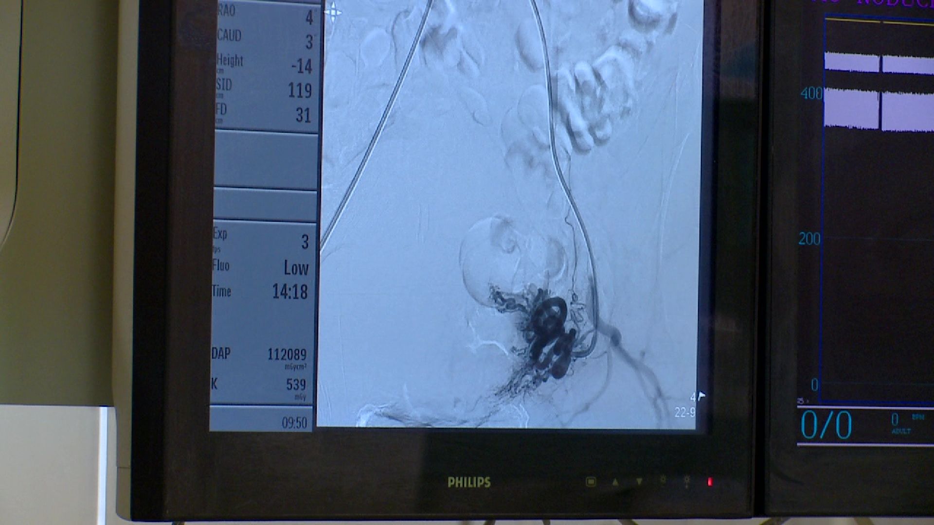 Реутов, медицина, здравоохранение, миома матки, лечение