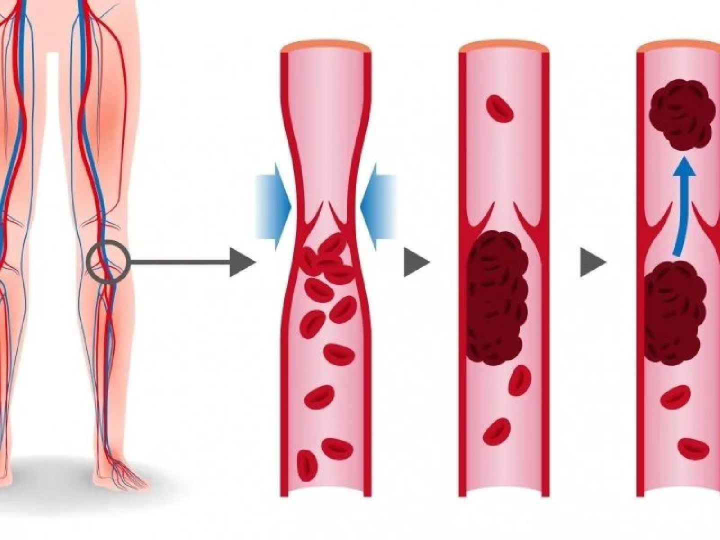 Тромбоз, флеболог, сосудистый хирург, фбуз мсч №9 фмба россии, Дубна