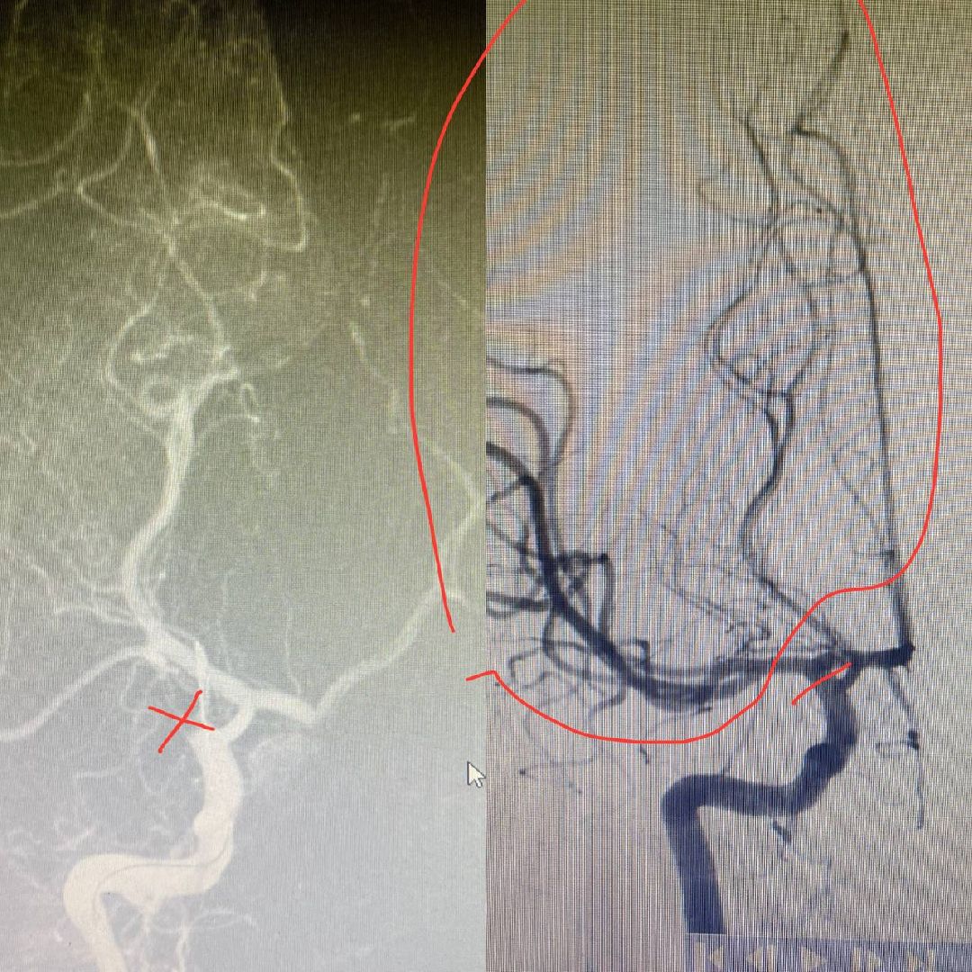 инсульт, юная, пациентка, ОКБ, Гегенава, Семёнов, Мартынович, Александра, операция, фенестарция, аневризма