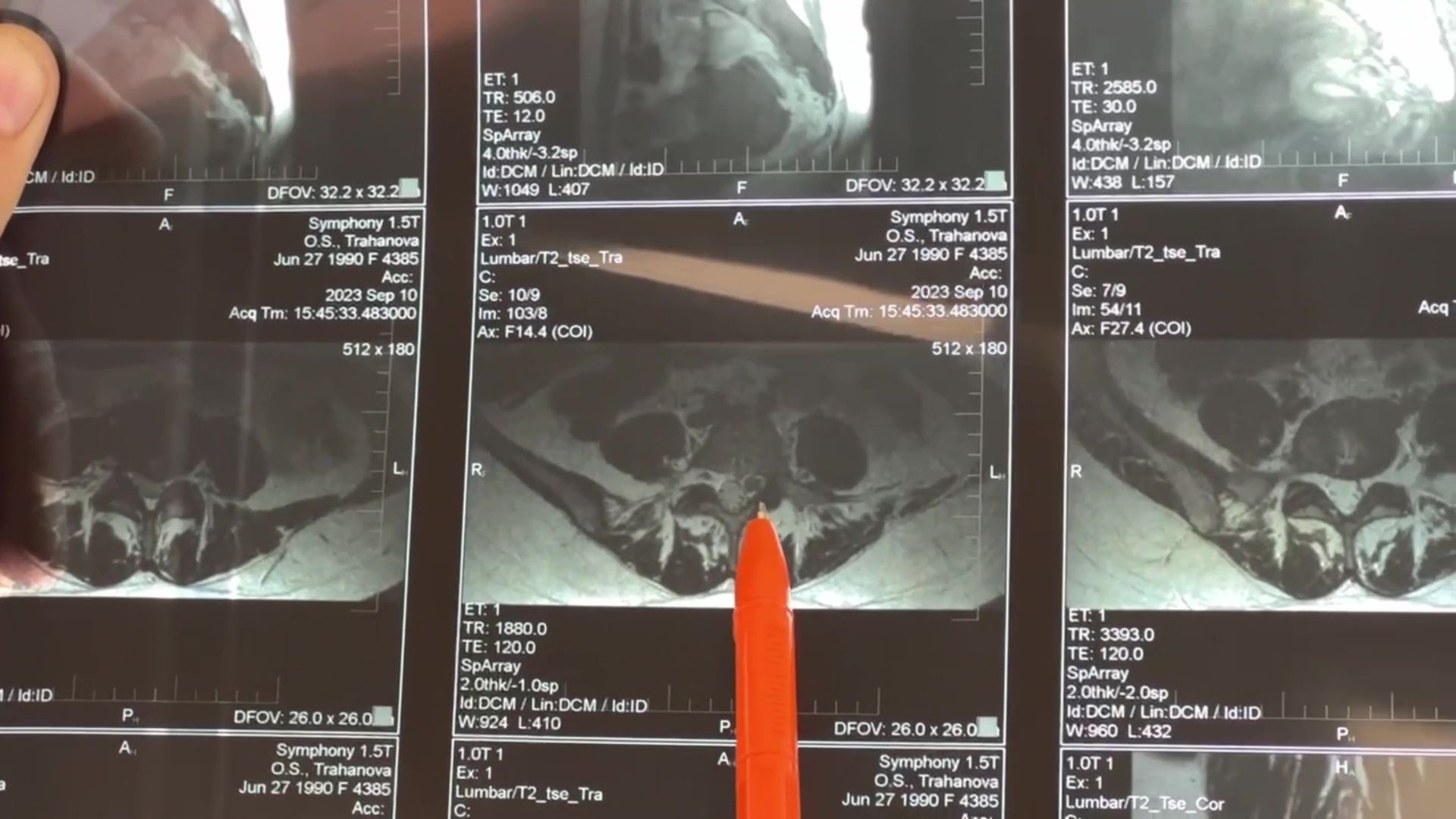 Реутов, Медицина, здравоохранение, врачи, операции, нейрогирургия,