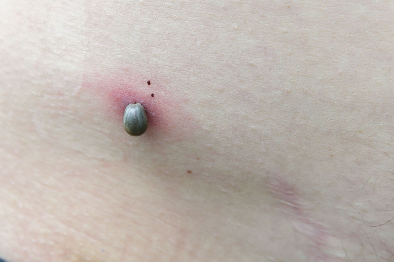 люберцы, клещи, травмпункт,