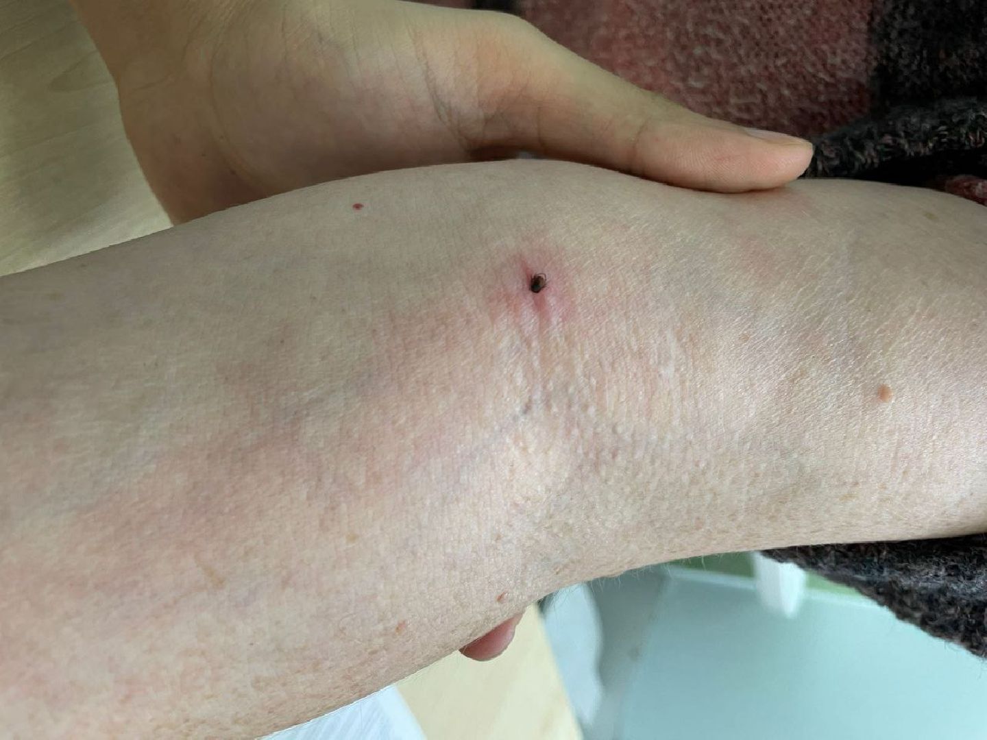 люберцы, клещи, травмпункт,