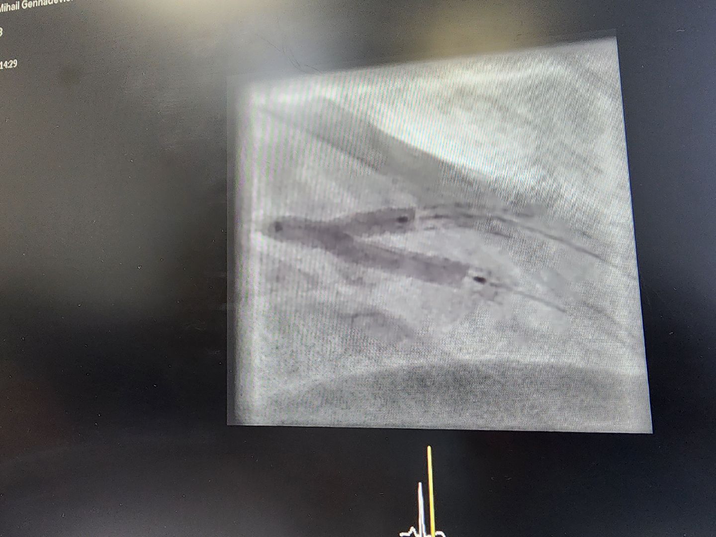 стентирование, Коронарный стент, сосудистый центр, фбуз мсч №9 фмба россии, Дубна,