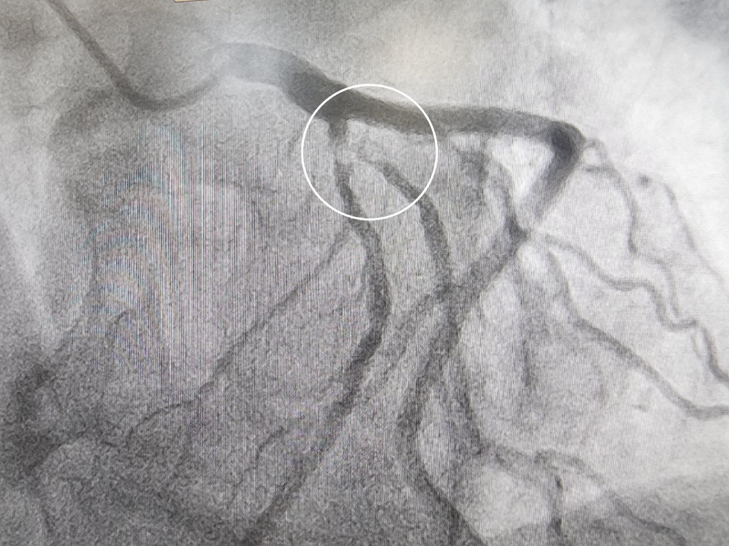стентирование, Коронарный стент, сосудистый центр, фбуз мсч №9 фмба россии, Дубна,