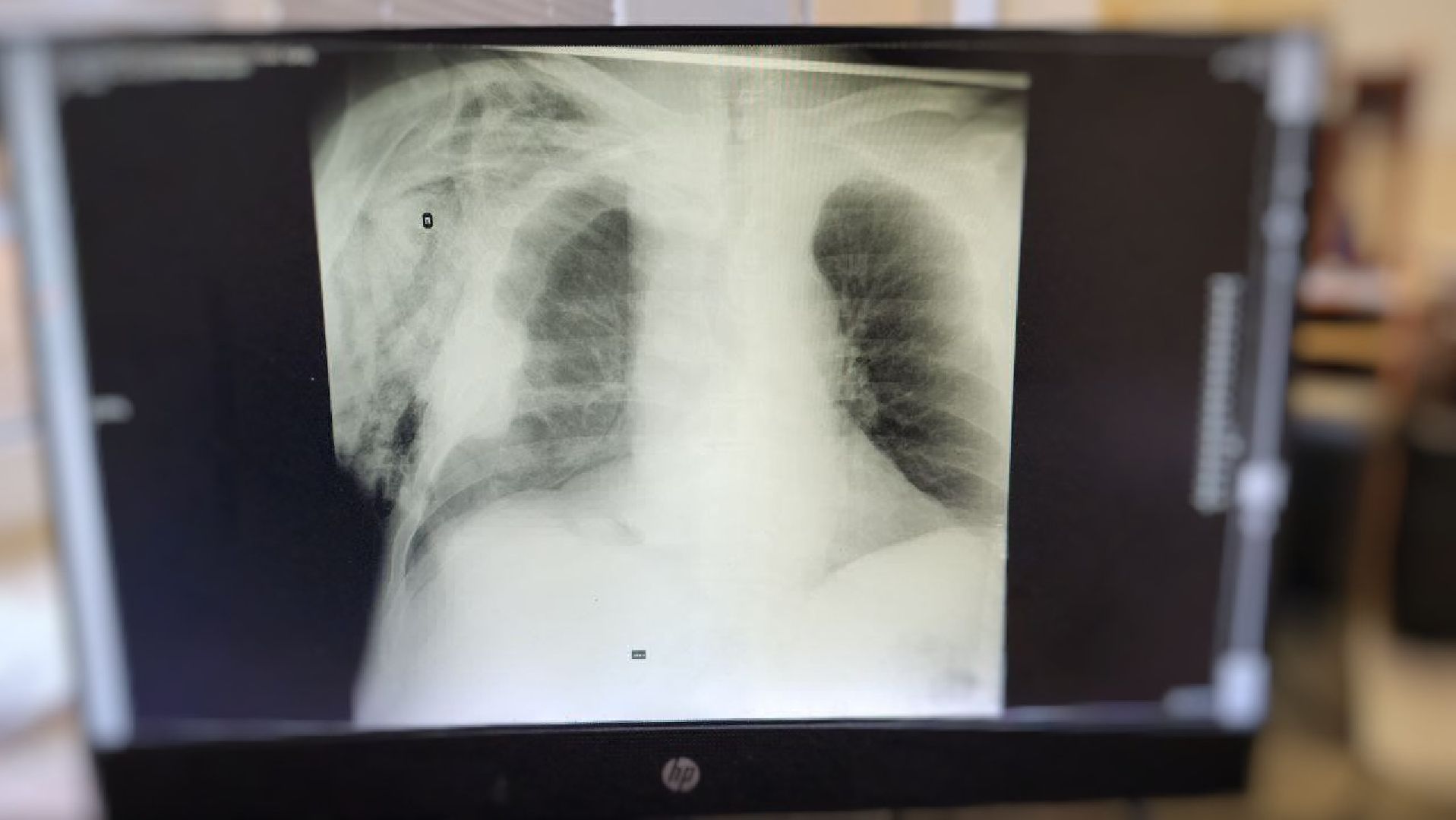 Солнечногорск, медицина, хирургия, спасение, грибы,