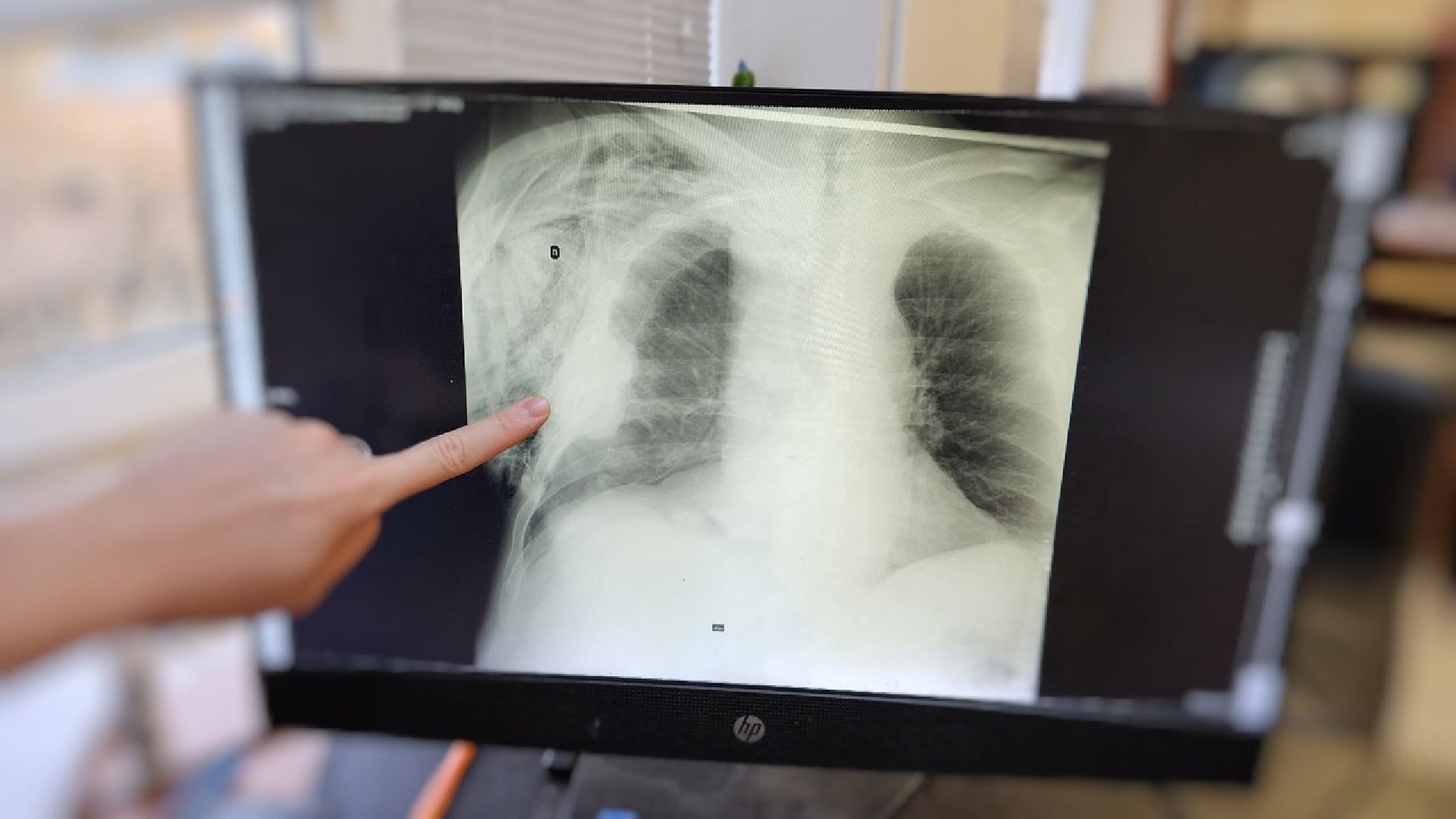 Солнечногорск, медицина, хирургия, спасение, грибы,