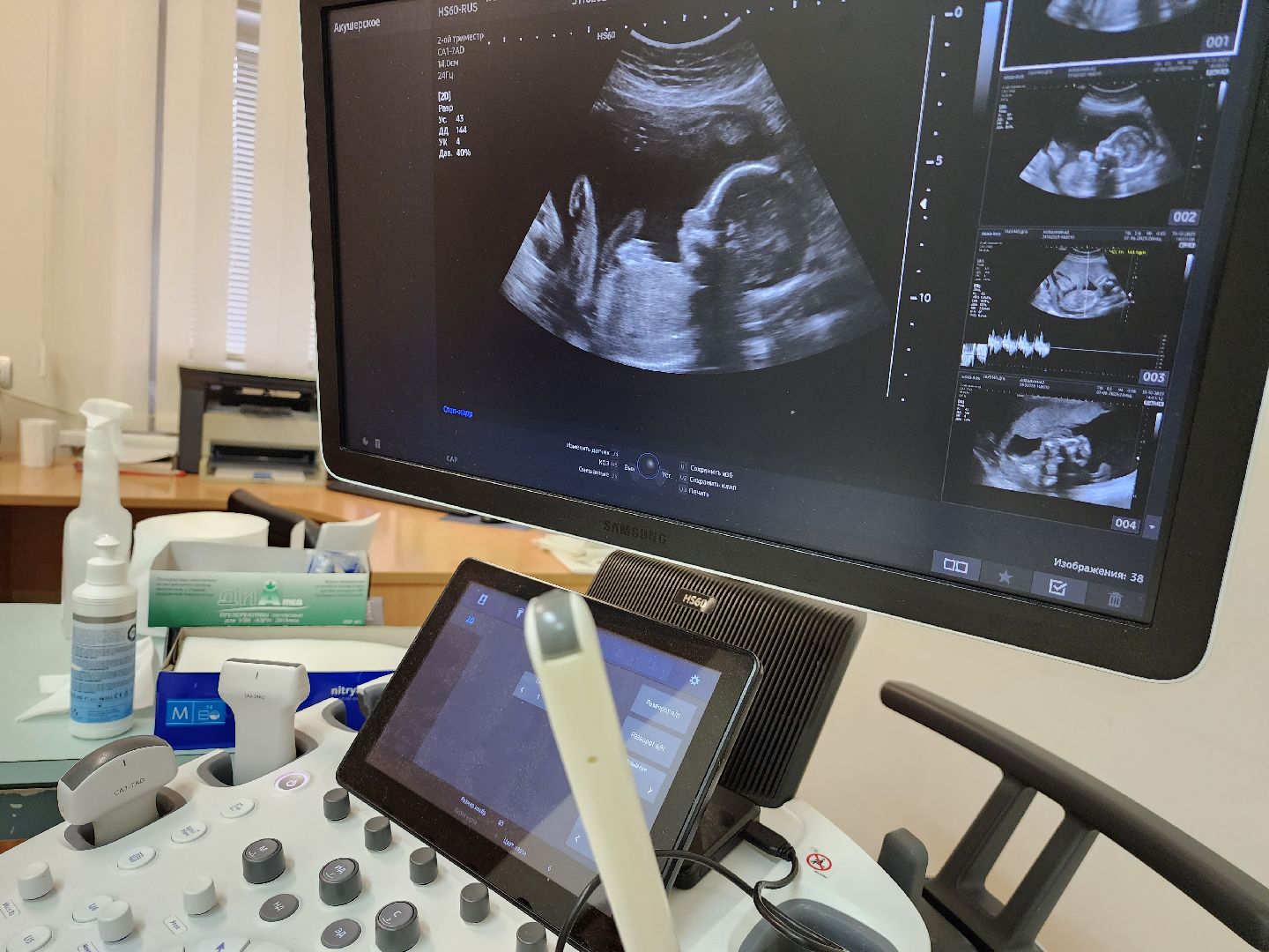 Пренатальный скрининг, Беременность, женская консультация, Женское здоровье, здравоохранение, дубненская больница, Дубна,