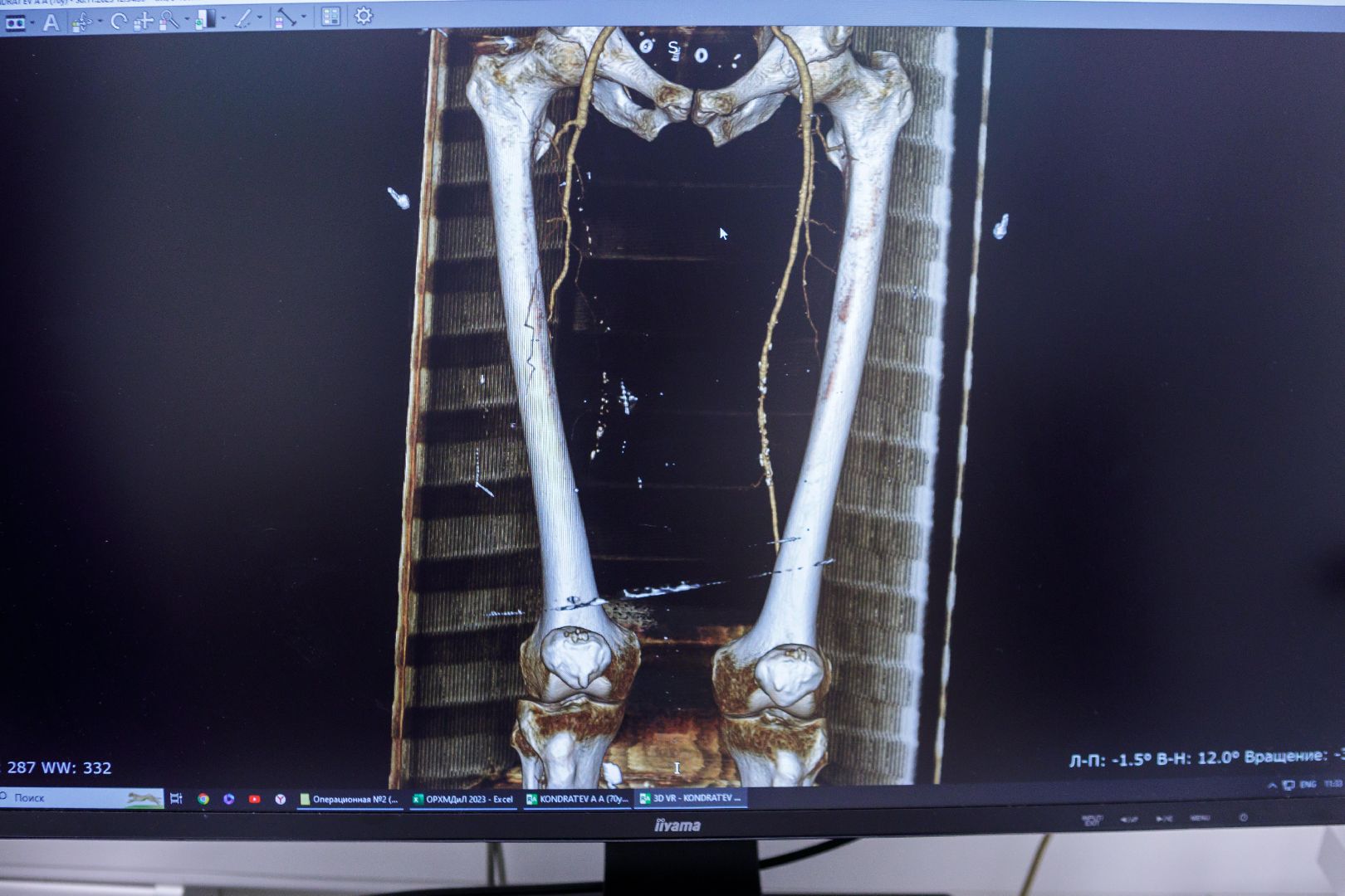 Люберцы, региональный сосудистый центр, диагностика, диабет,