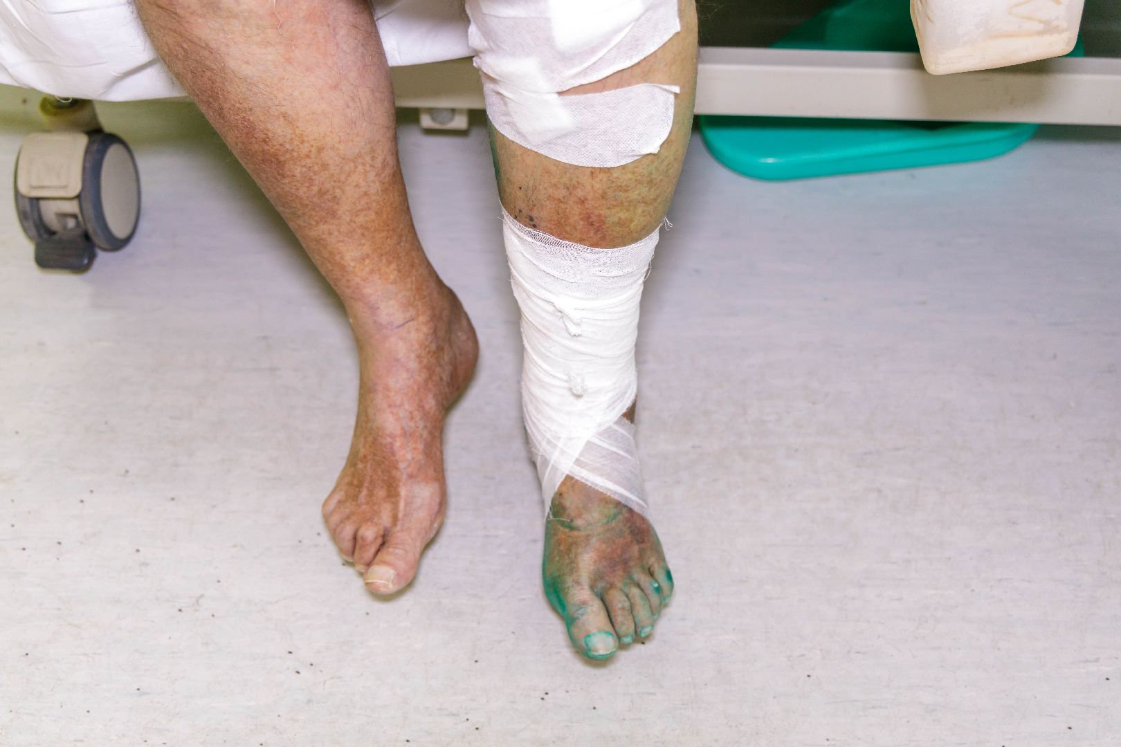 Люберцы, люберецкая областная больница, малоинвазивные операции,