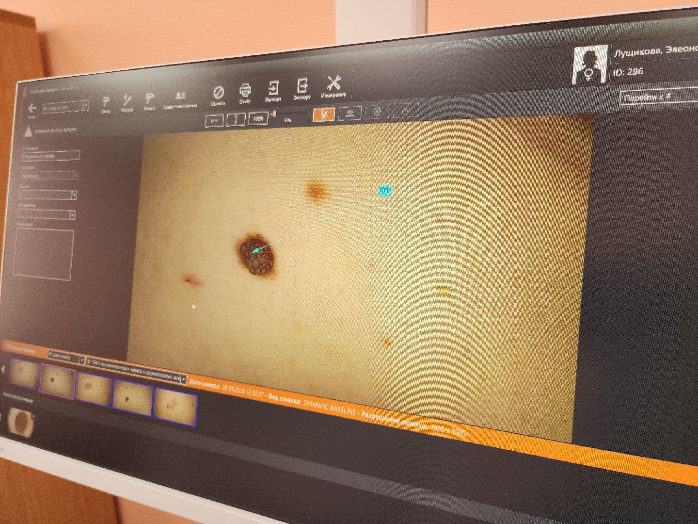 коломна, медицина, скриннинг рака кожи,