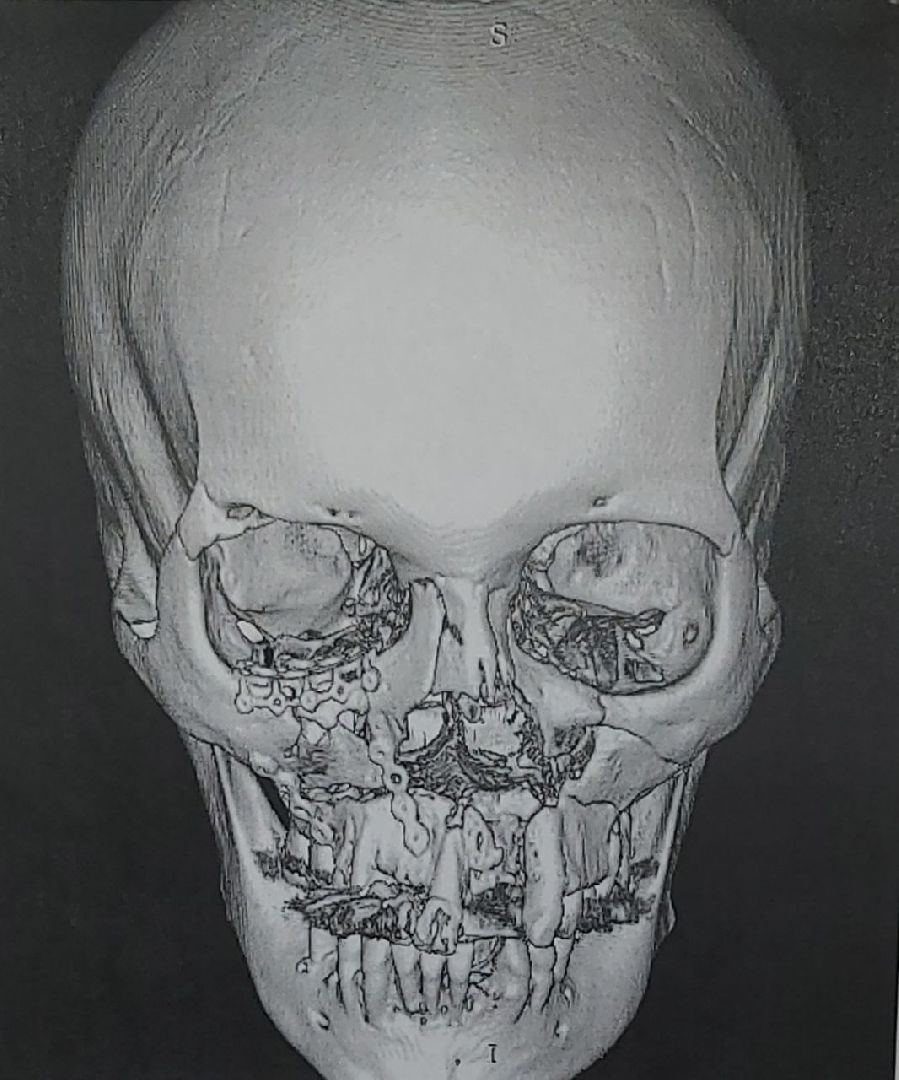 Жуковская ОКБ, отделение ЧЛХ, челюстно-лицевая хирургия, операция, Тотладзе, Никитин,