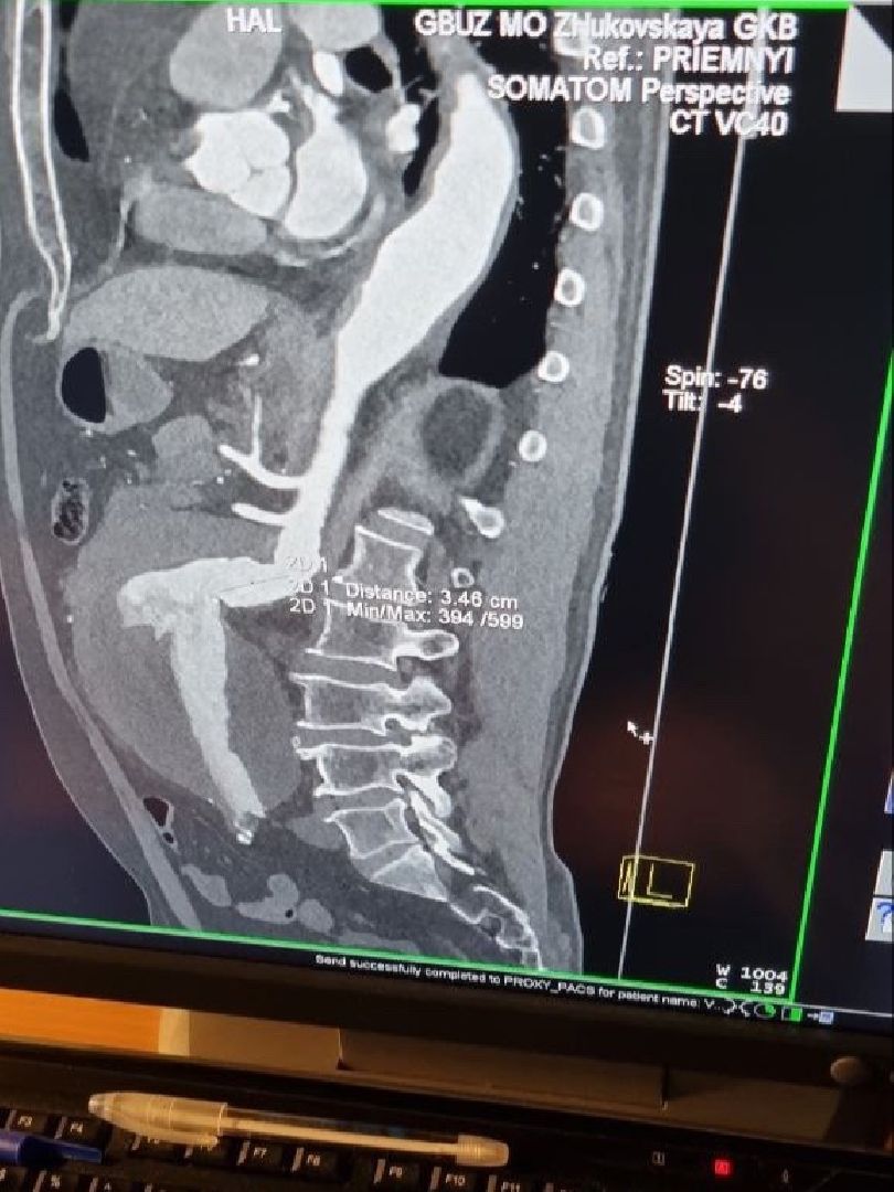 операция, сосудистый хирург, Владимир Никольский, Эдуард Семенов, Алена Матвеевская, Ильяз Мустафоев, анверизма, брюшная аорта,
