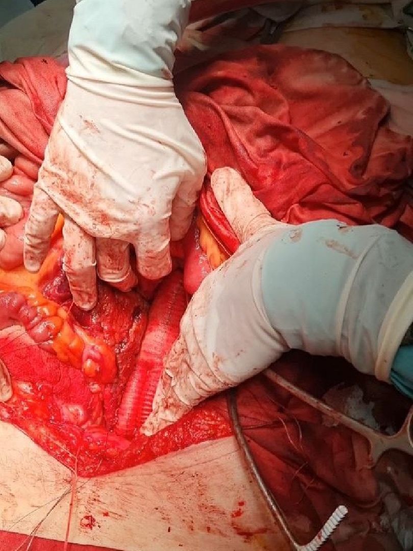 операция, сосудистый хирург, Владимир Никольский, Эдуард Семенов, Алена Матвеевская, Ильяз Мустафоев, анверизма, брюшная аорта,