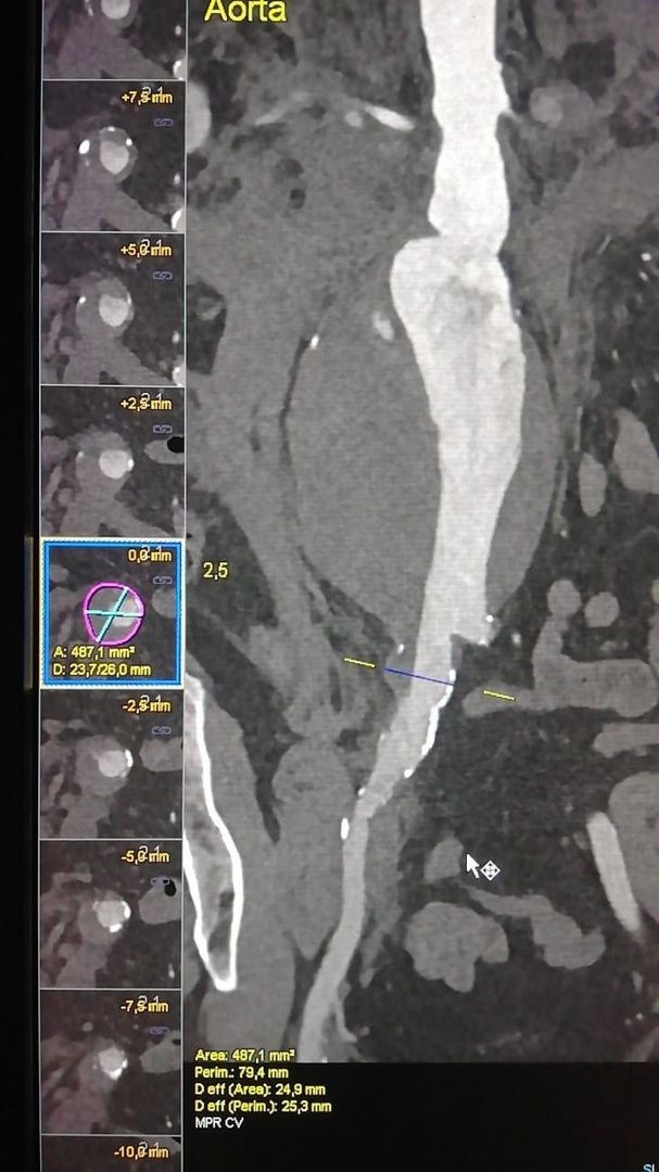 операция, сосудистый хирург, Владимир Никольский, Эдуард Семенов, Алена Матвеевская, Ильяз Мустафоев, анверизма, брюшная аорта,