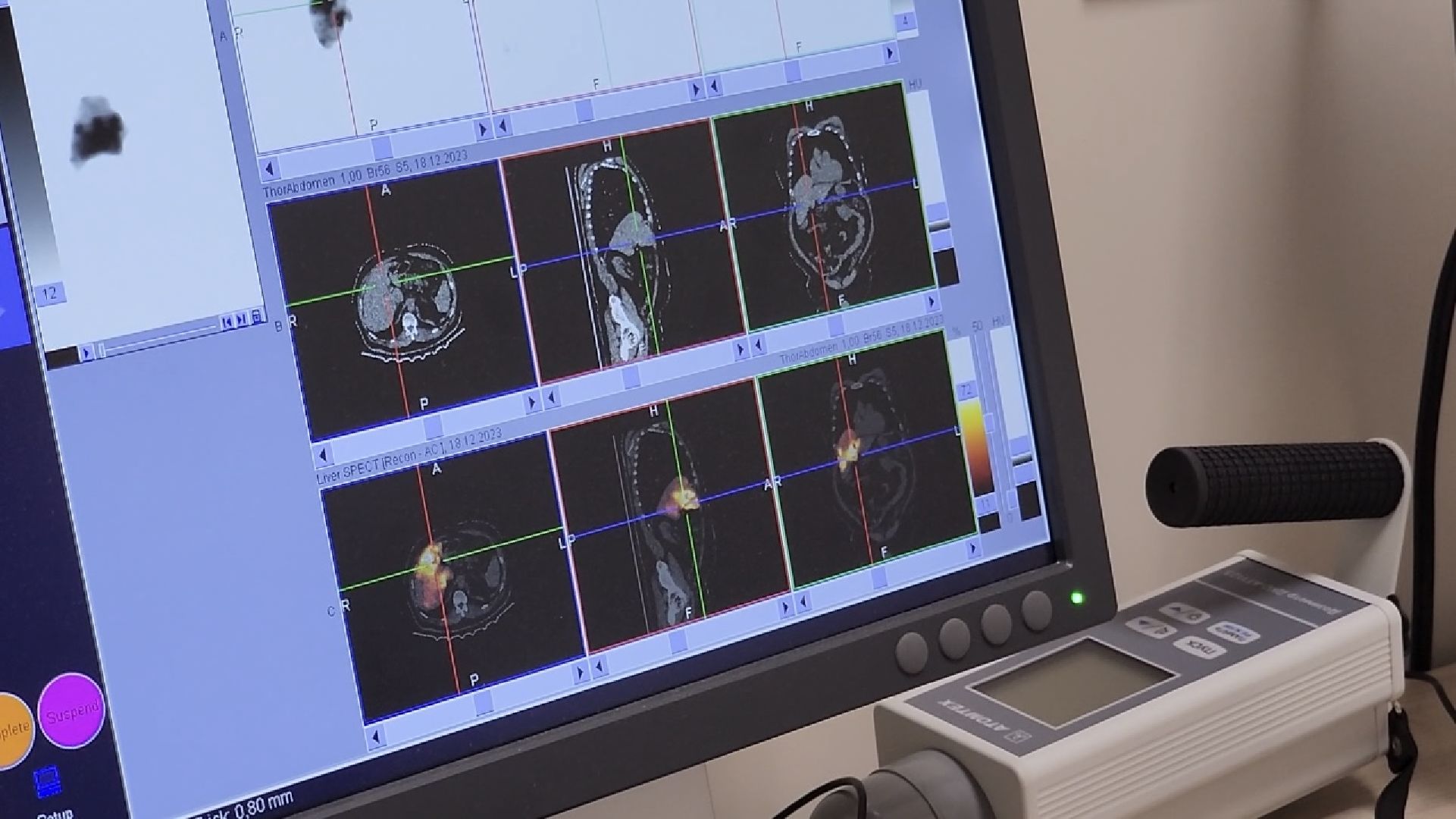 химки, медицина, операция, рак, клиника,