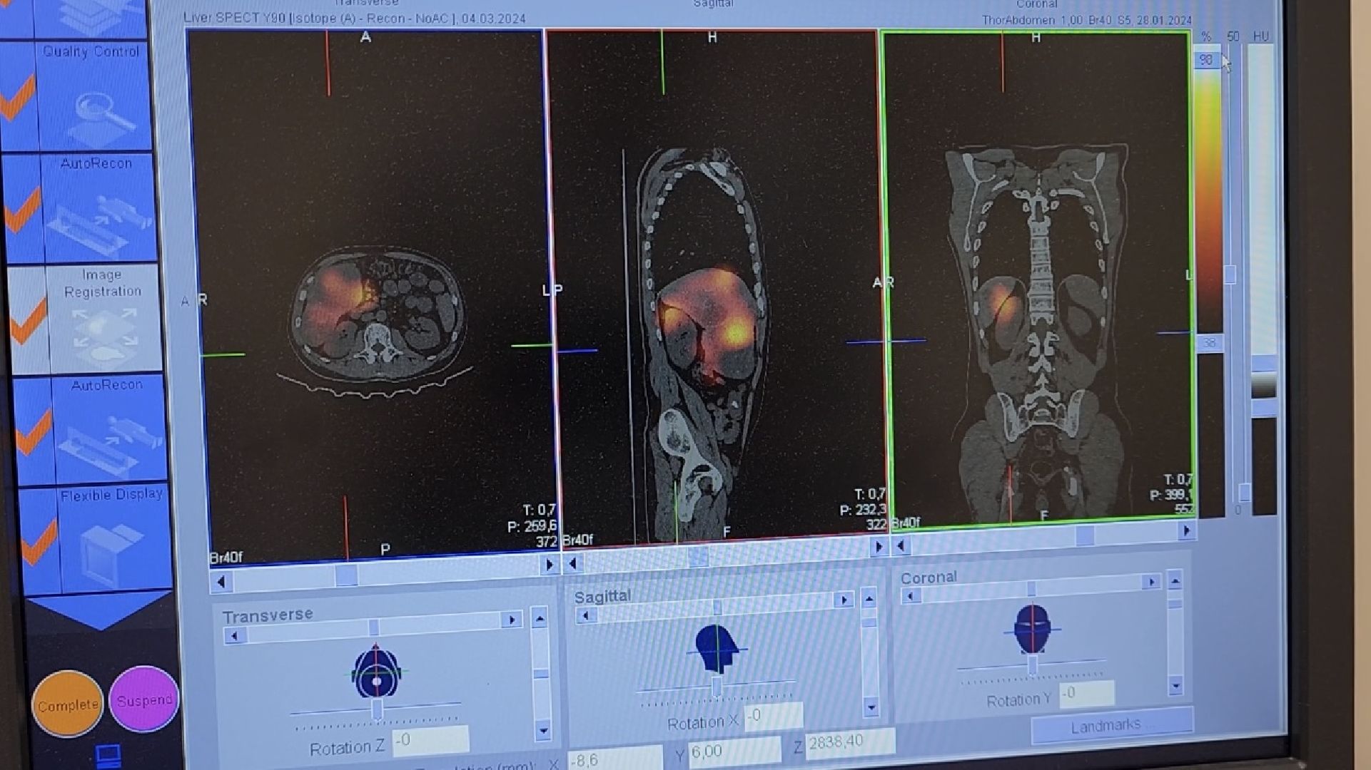 химки, медицина, операция, рак, клиника,