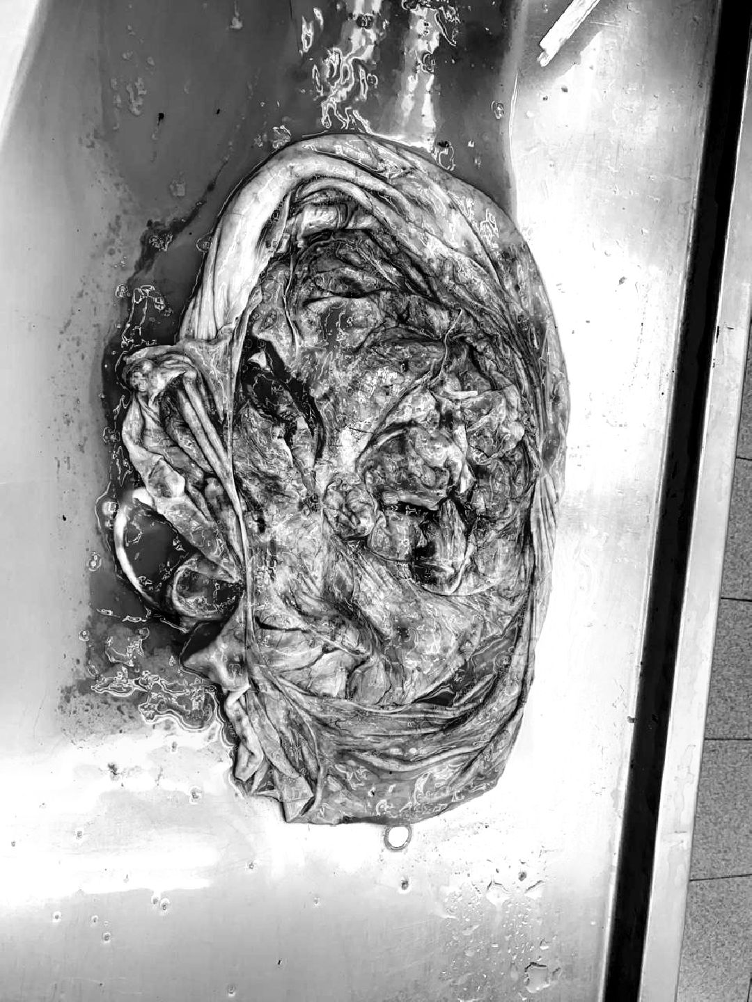 Подольск, медицина, опухоль, здоровье