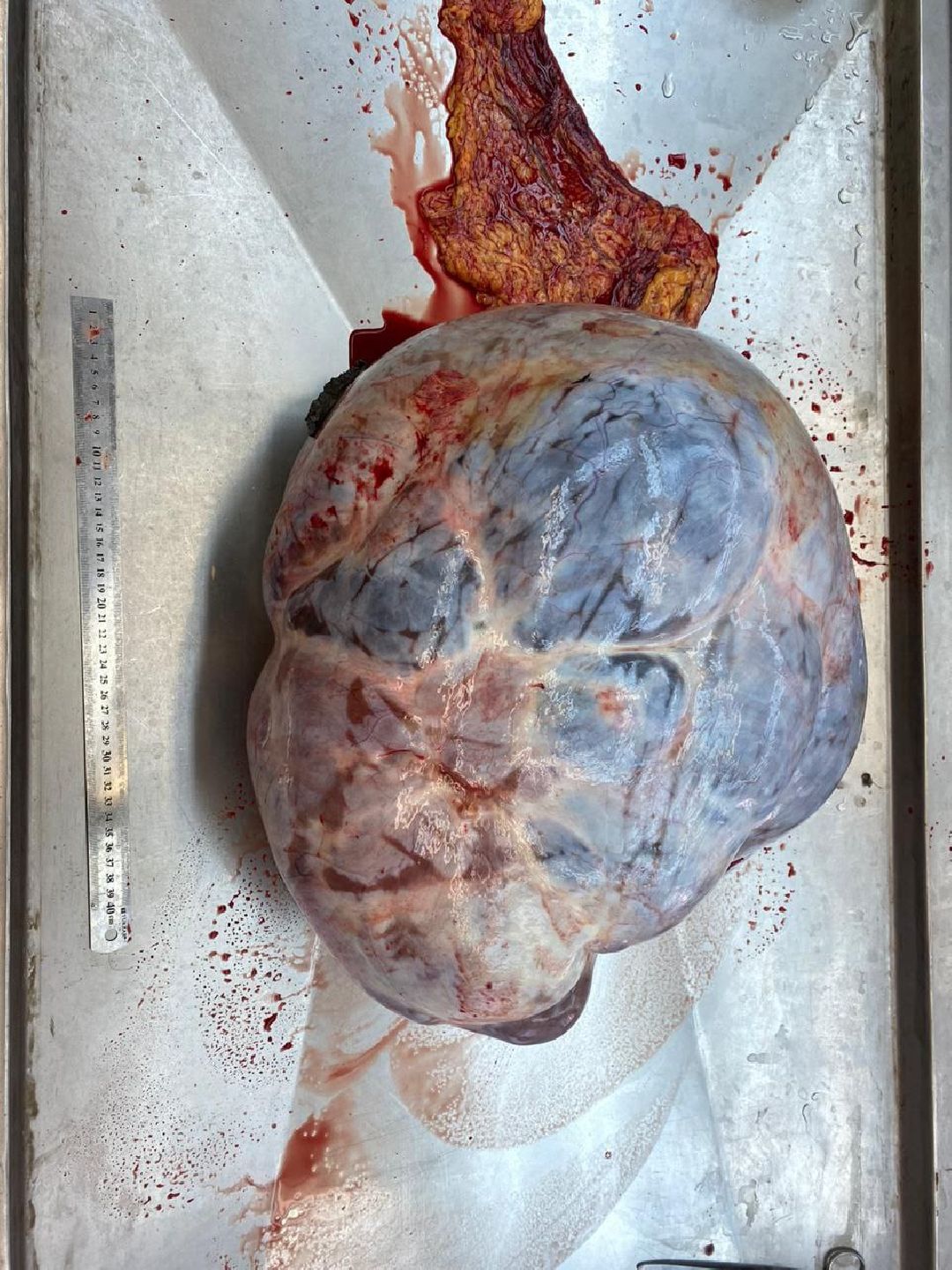 Подольск, медицина, опухоль, здоровье