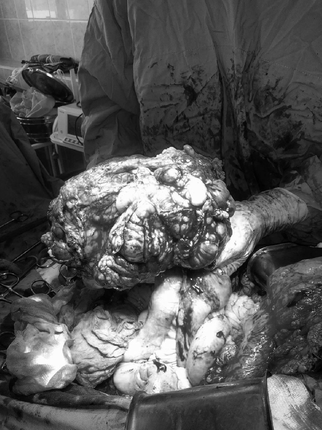 Подольск, медицина, опухоль, здоровье