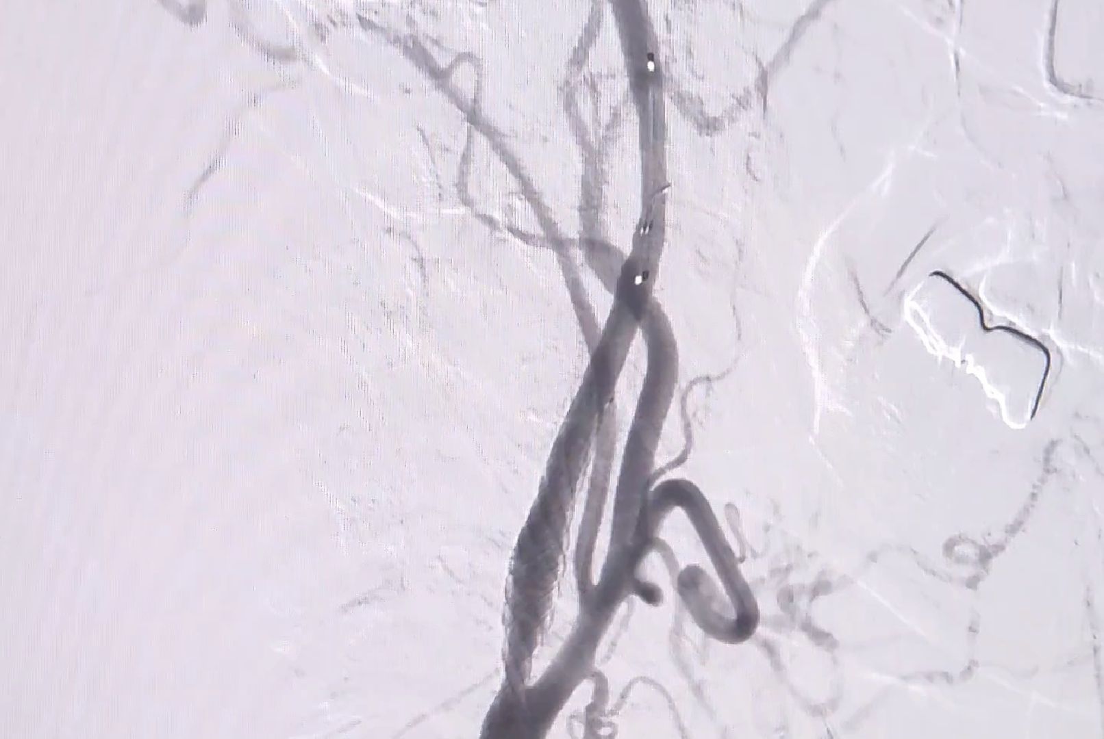 фбуз мсч №9 фмба россии, Дубна, Сосудистый центр, малоинвазивные операции, Операция на сосудах мозга,