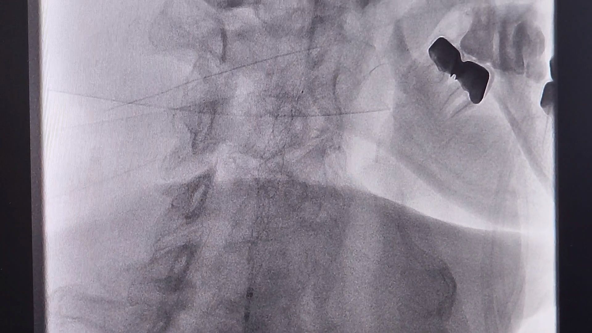 фбуз мсч №9 фмба россии, Дубна, Сосудистый центр, малоинвазивные операции, Операция на сосудах мозга,