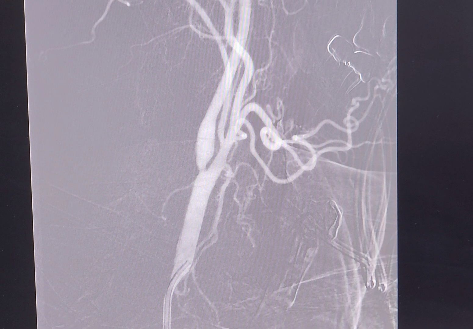 фбуз мсч №9 фмба россии, Дубна, Сосудистый центр, малоинвазивные операции, Операция на сосудах мозга,