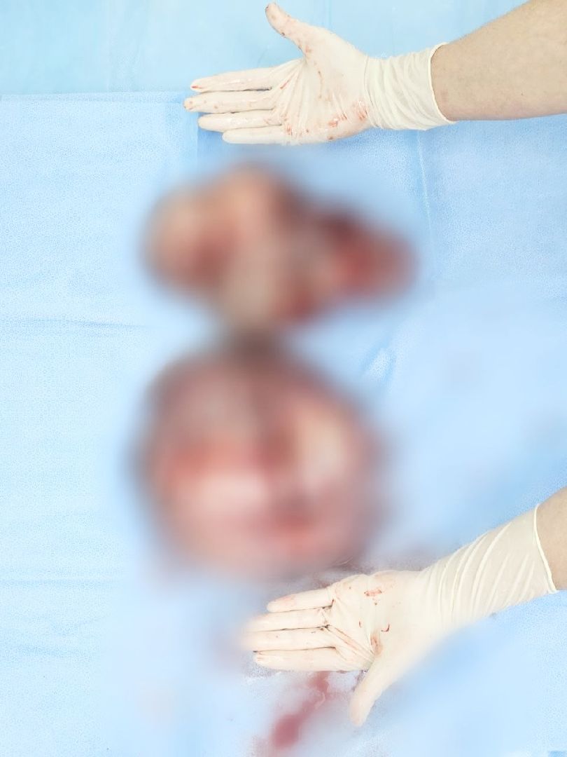 балашиха, Подмосковье, Онкология, гигантская опухоль, московский областной онкологический диспансер,