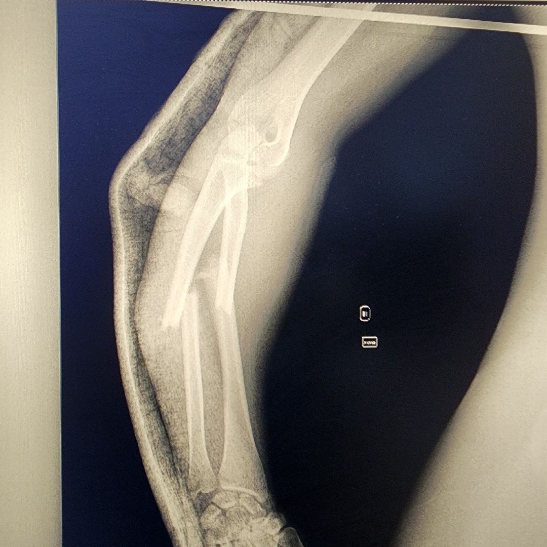 Солнечногорск, медицина, травматология, история спасения,