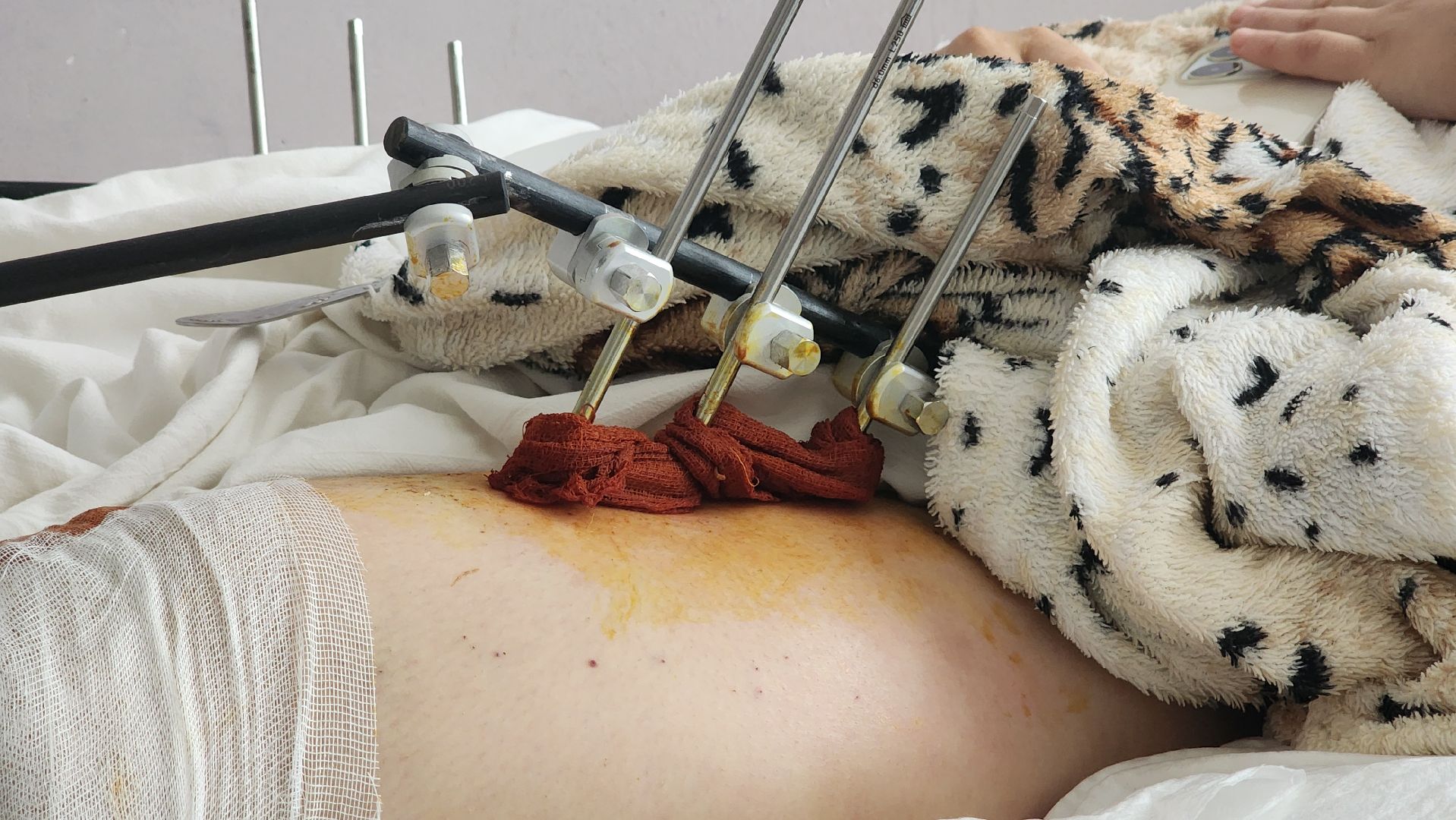 Солнечногорск, медицина, травматология, история спасения,