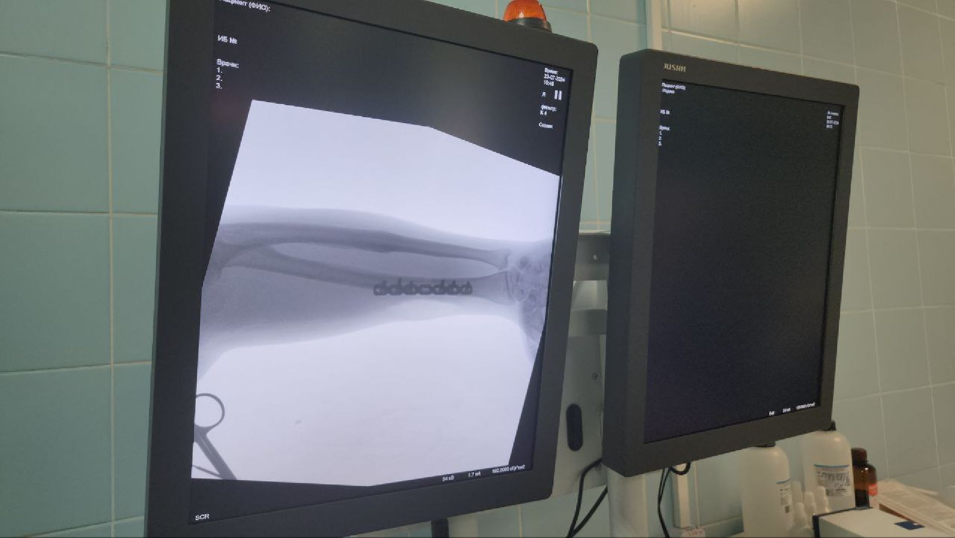 люберецкая областная больница, травматологи, пациенты, рентген, оборудование,