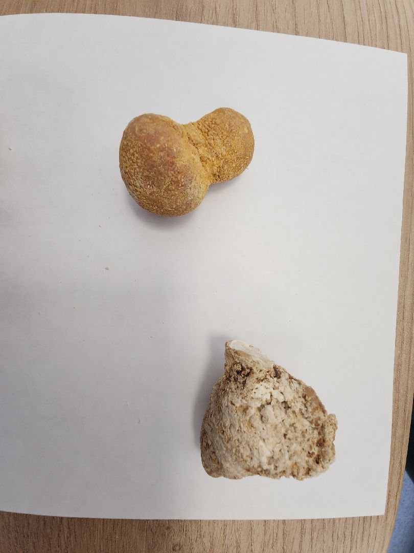 урология, камни в почках, профилактика болезней, советы врачей,