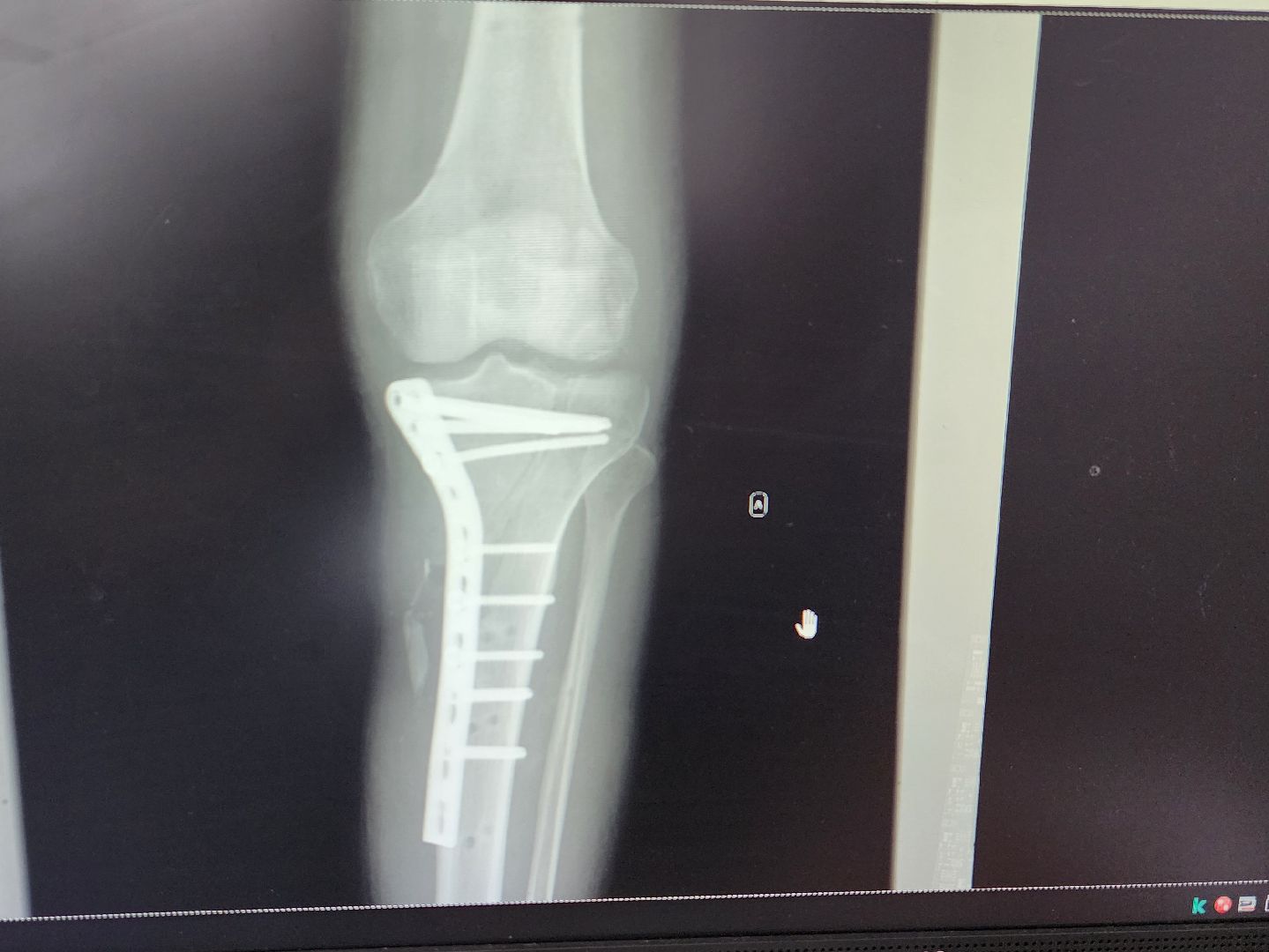 Солнечногорск, медицина, травматология, ДТП,