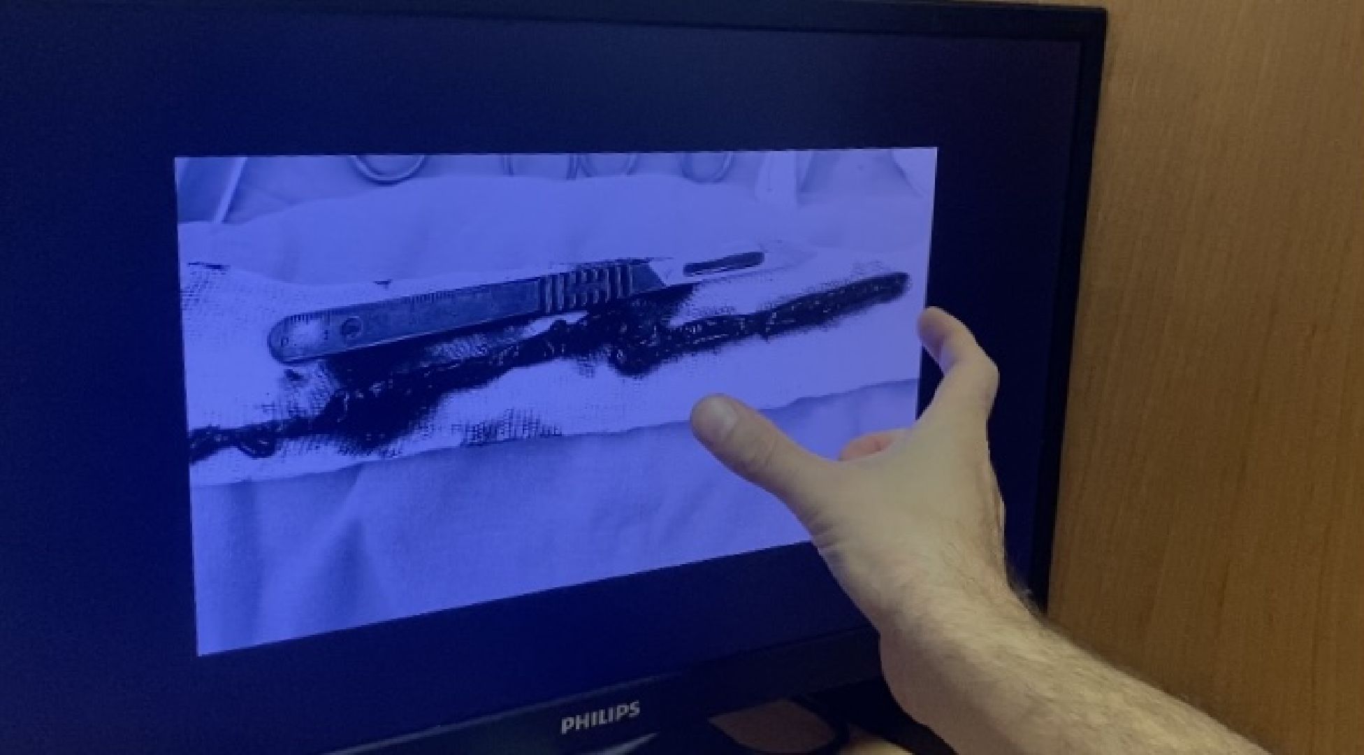 Коломна, Врач сосудистый хирург, коломенская больница, Сложная операция,