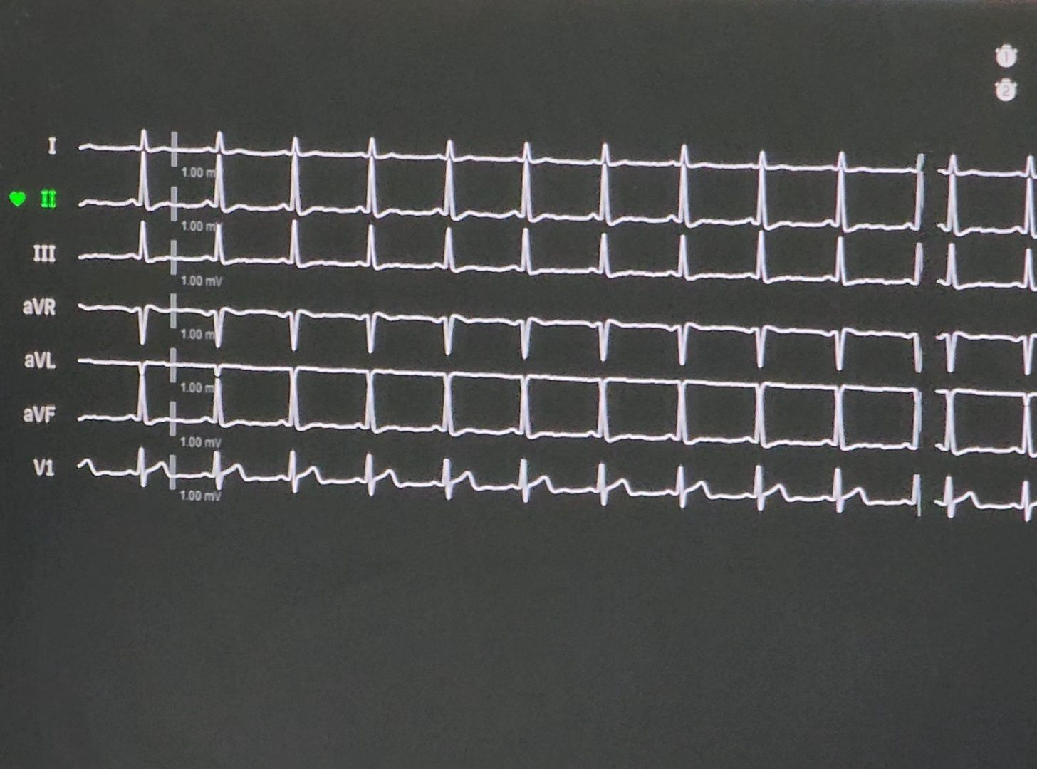 Дубна, фбуз мсч №9 фмба россии, Сосудистый центр, Операция, Профилактика инсульта,