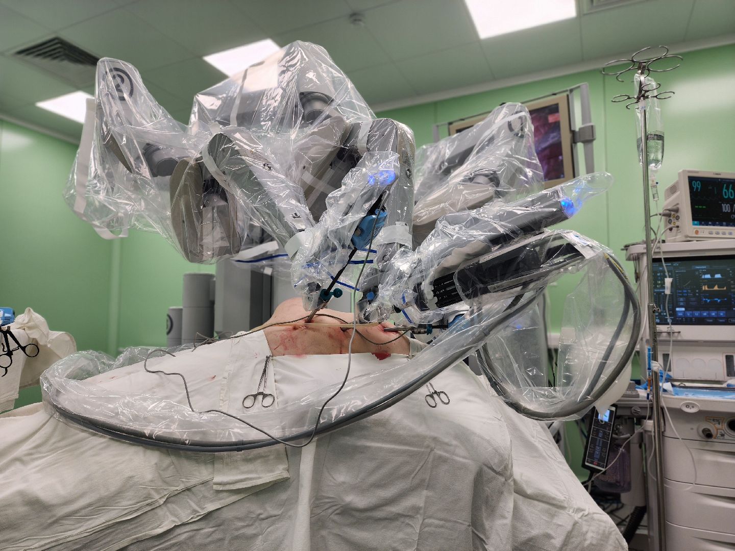 воскресенск, здравоохранение мо, операция, робот da vinci,