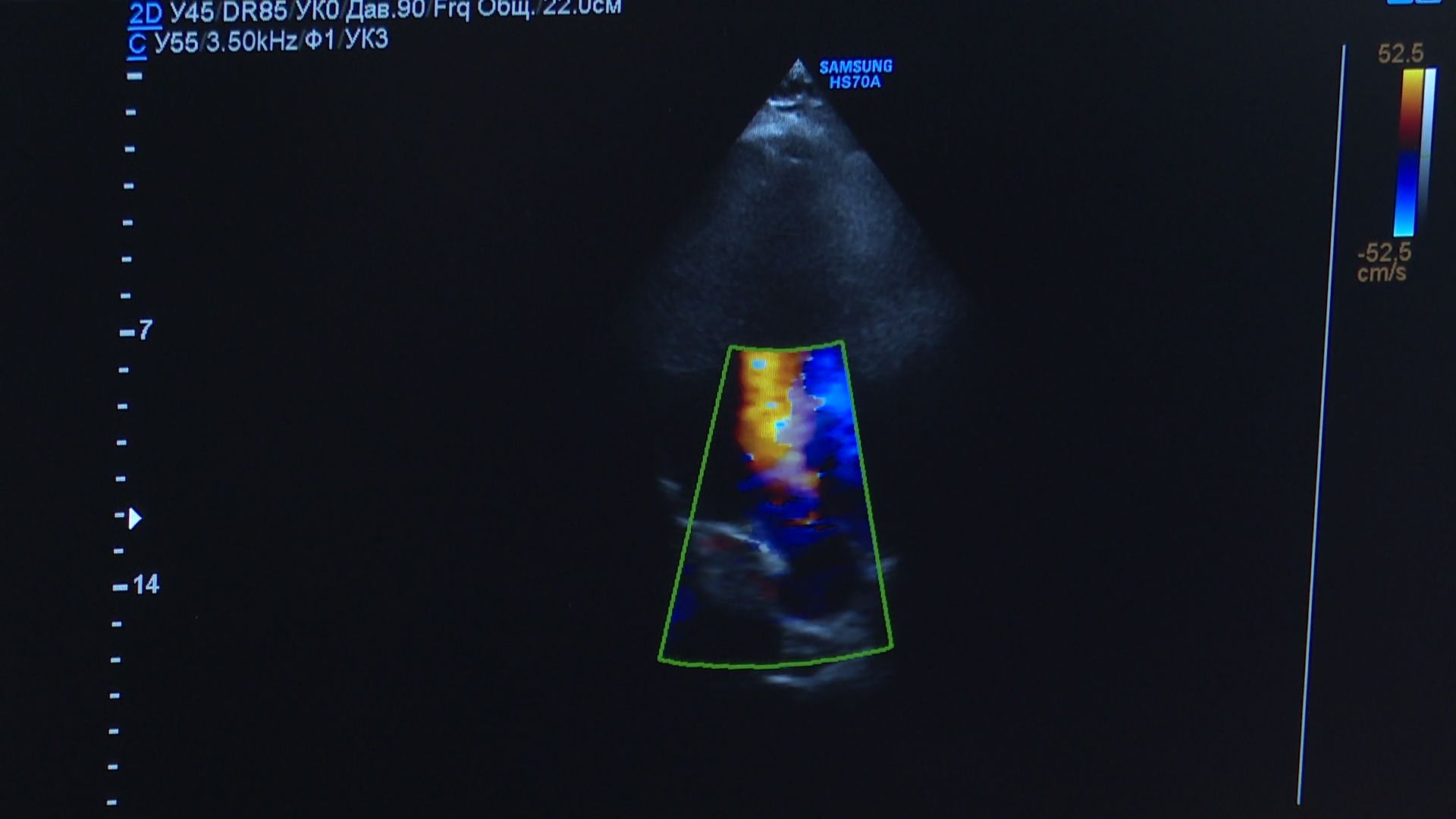 Реутов, вертикалки, здравоохранение, медицина, ЭКГ, сердечно-сосудистые заболевания, стресс-тестирование,