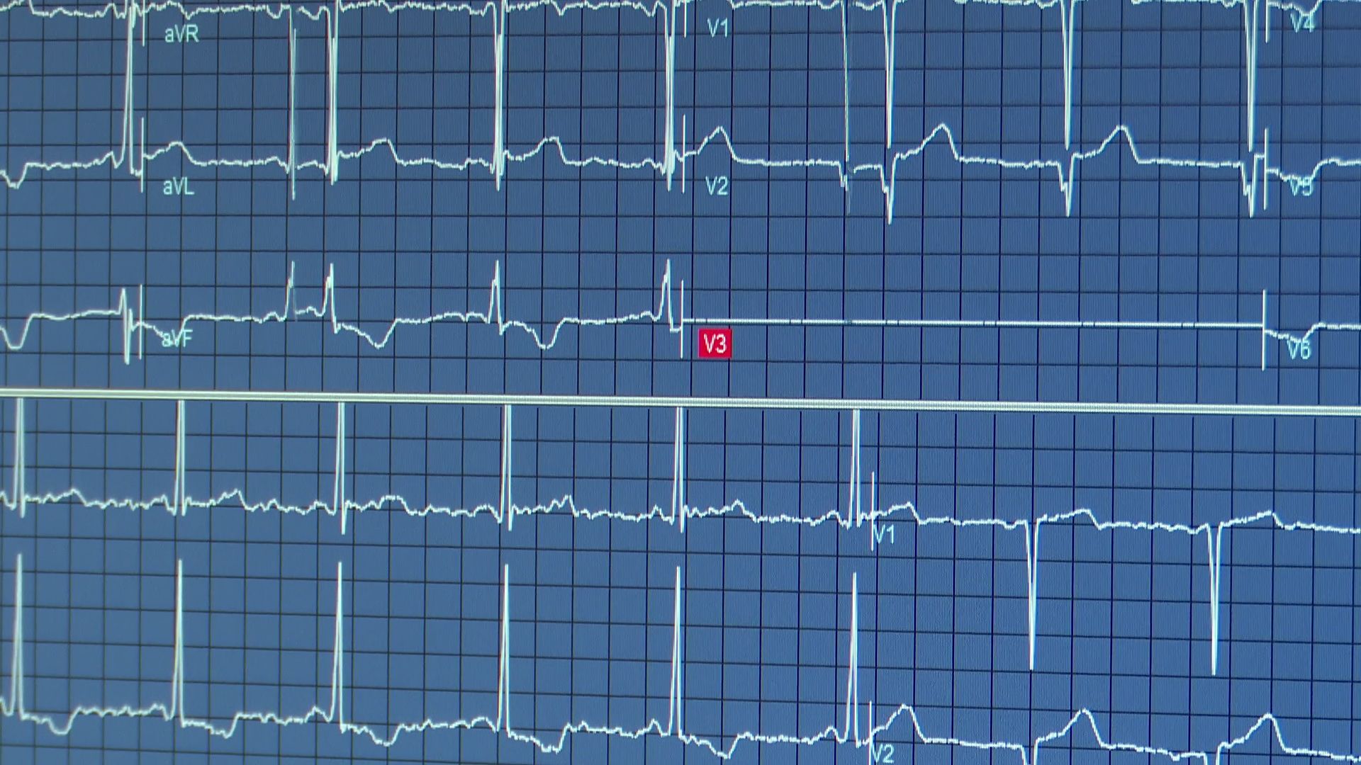 Реутов, вертикалки, здравоохранение, медицина, ЭКГ, сердечно-сосудистые заболевания, стресс-тестирование,