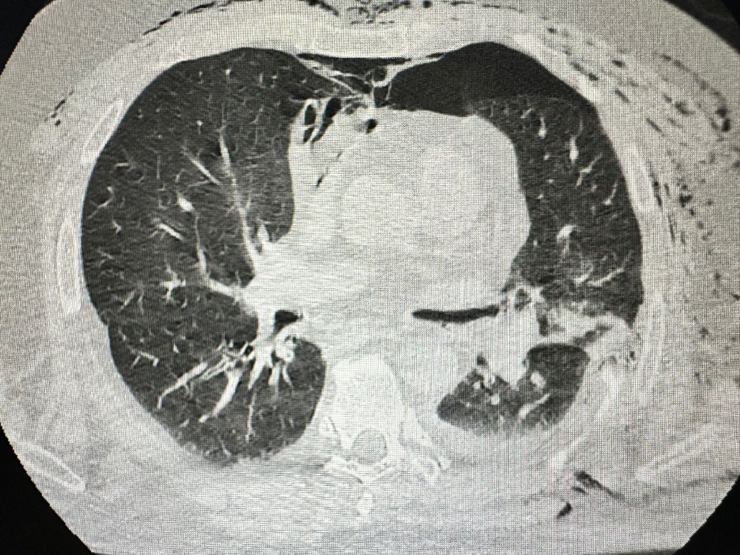 история спасения, реанимация, хирургия, падение с высоты, вертикалки,