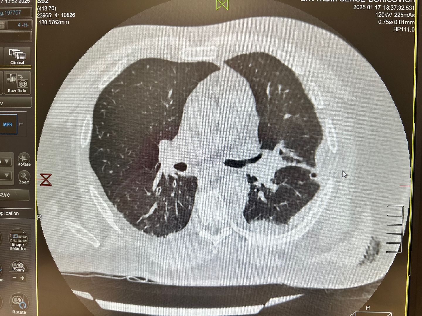 история спасения, реанимация, хирургия, падение с высоты, вертикалки,