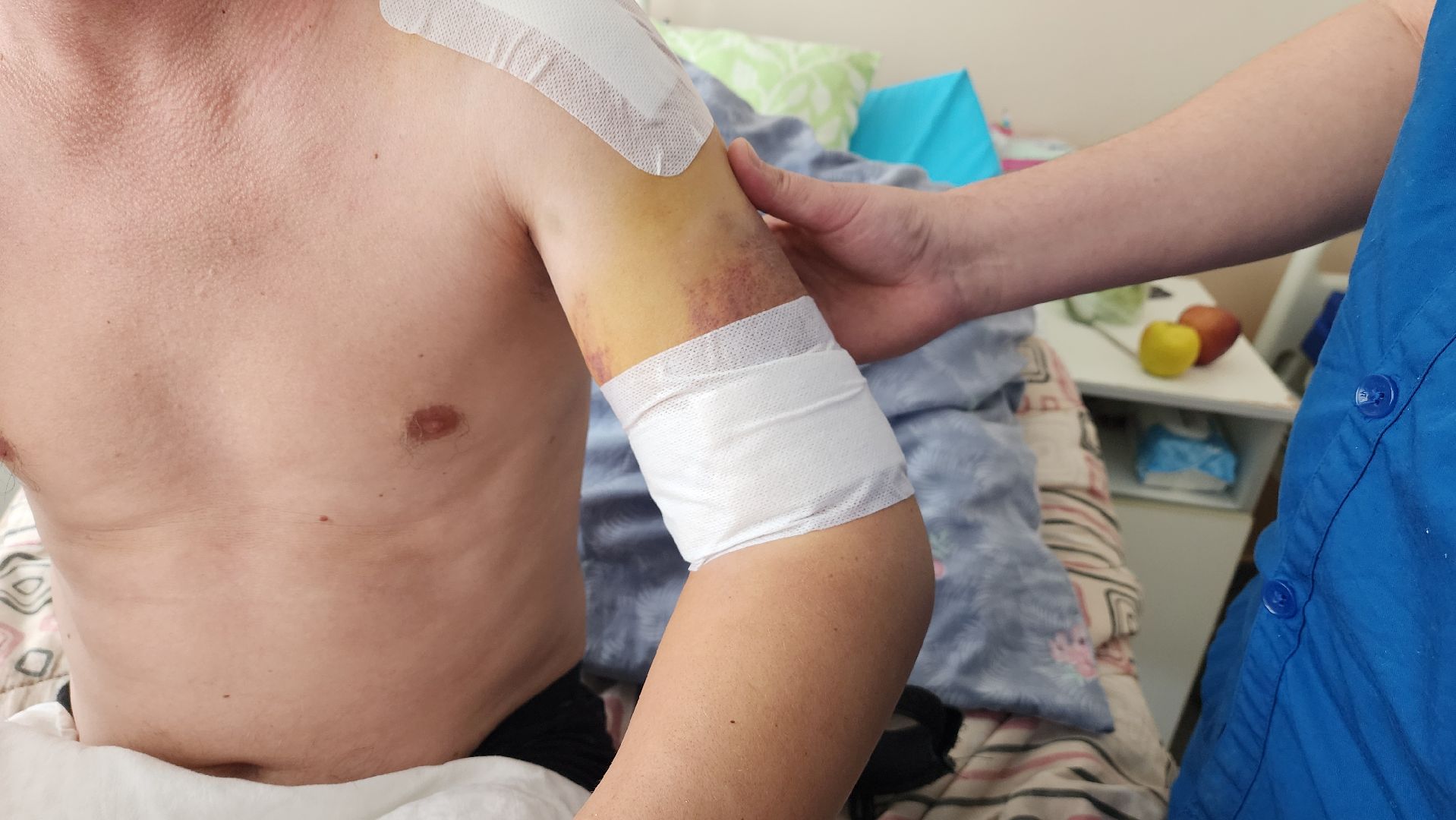 солнечногорск, медицина, травматология, падение с высоты,