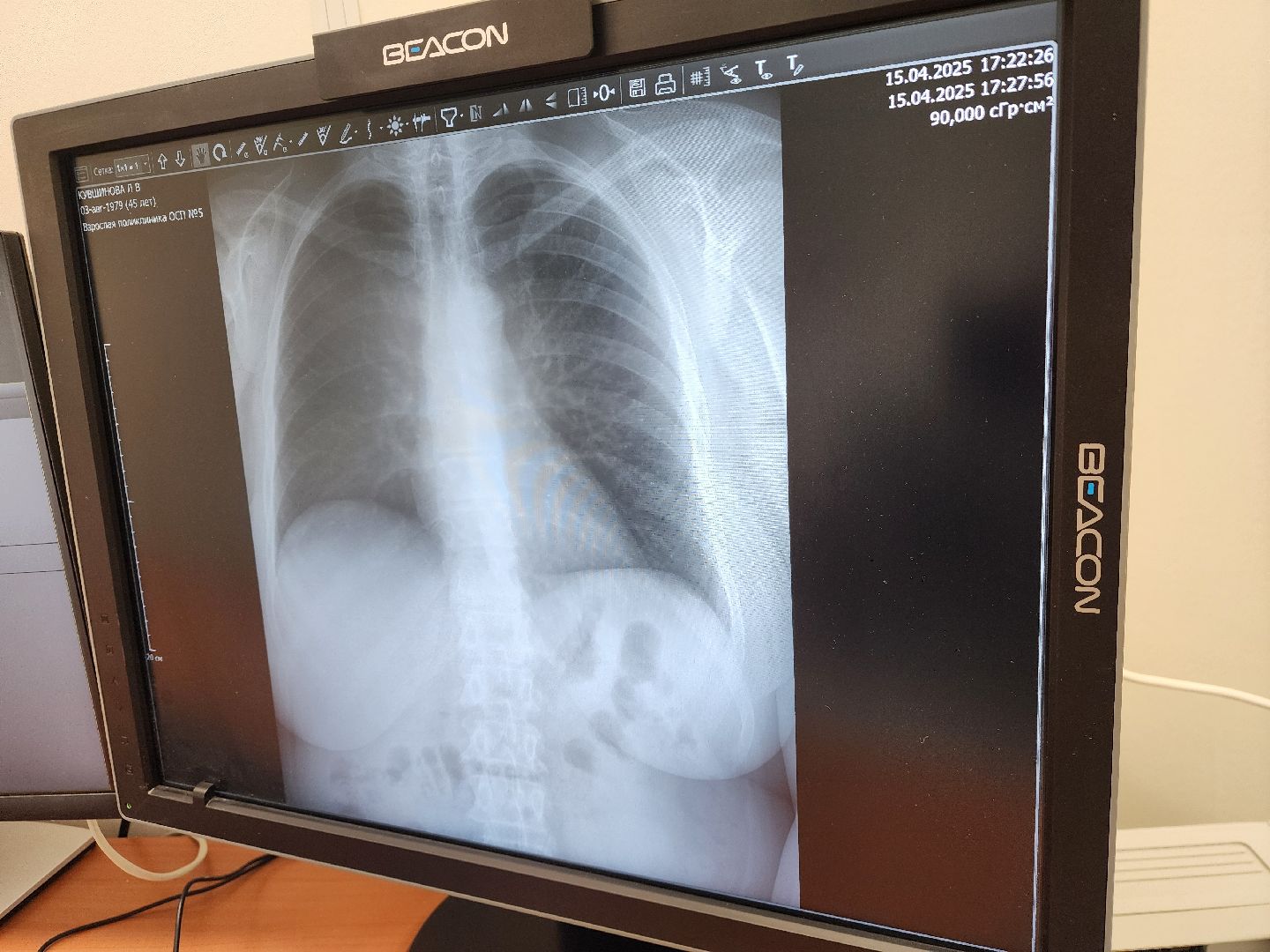 подольск, рентген-аппарат, покб,