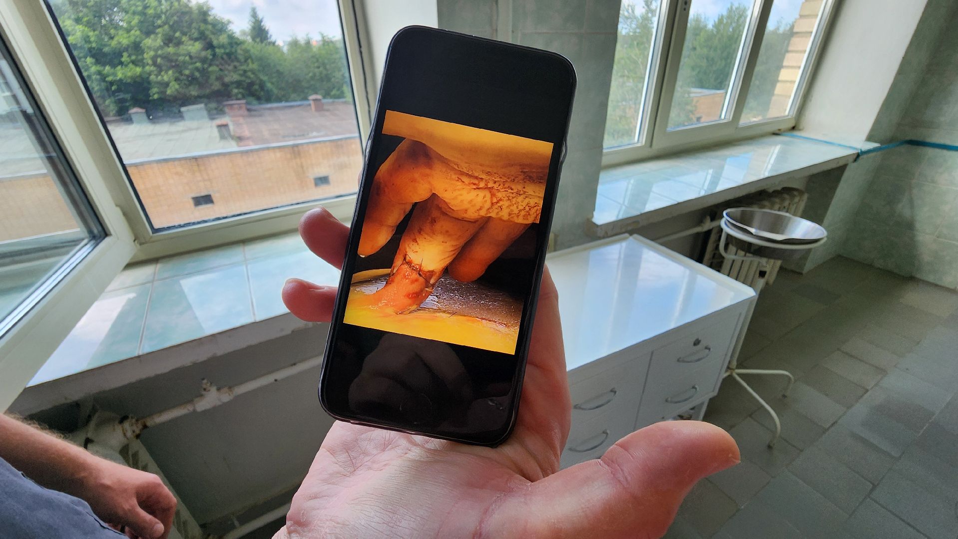 солнечногорск, медицина, травматология, операция,