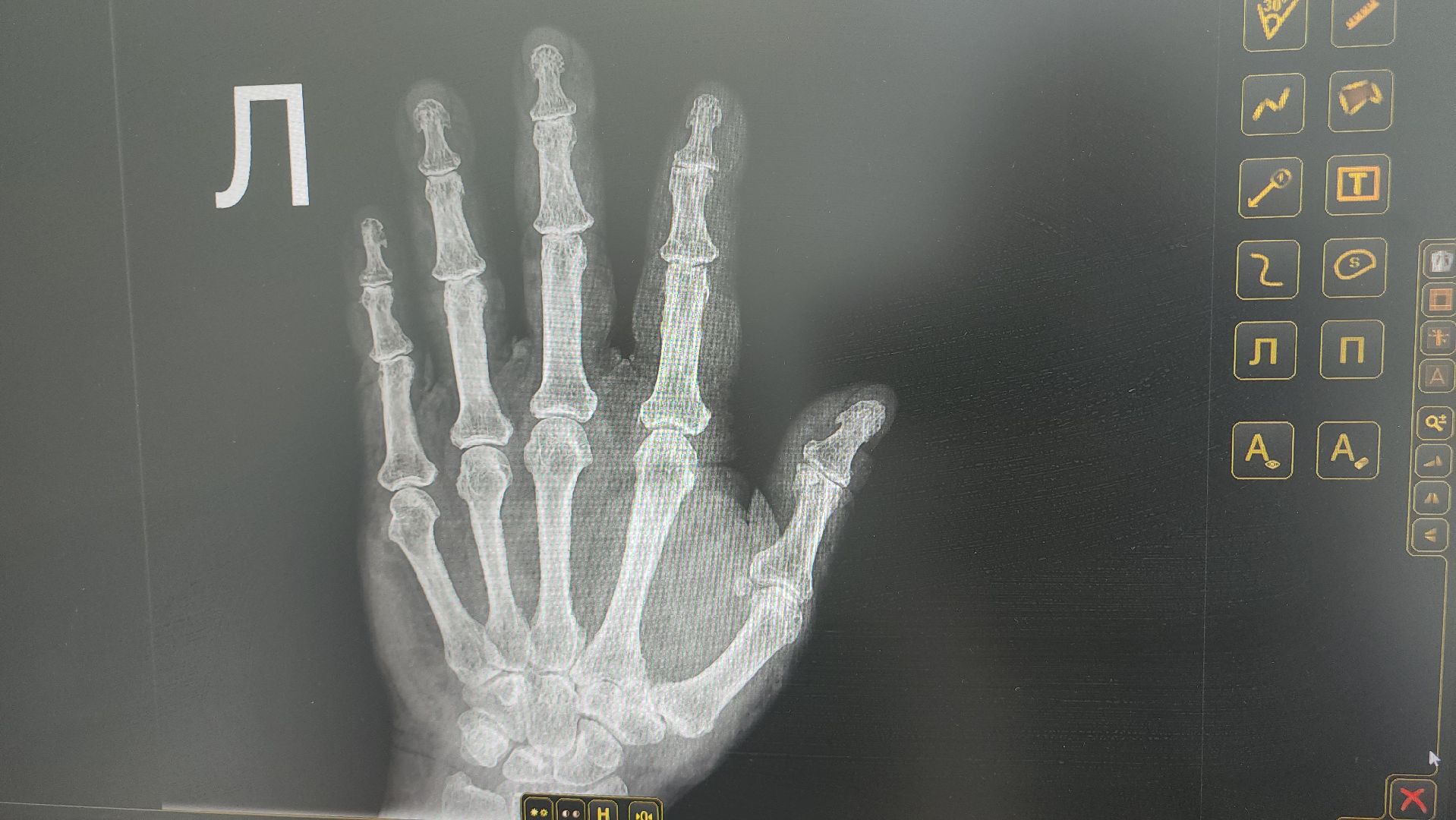 Люберцы, новый рентген аппарат, люберецкая областная больница, рп Октябрьский,