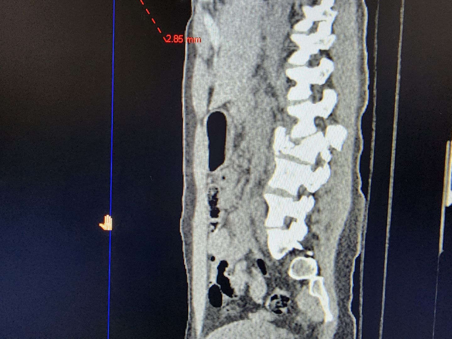 подольск, Происшествие , падение с высоты,Подольская детская больница ,