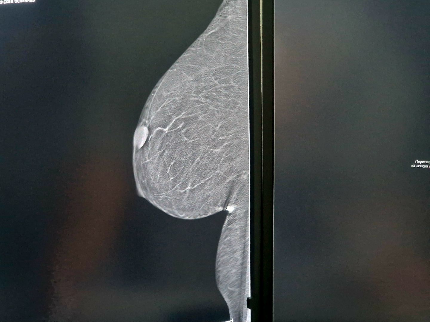 воскресенск, воскресенская больница, маммография, рак молочной железы,