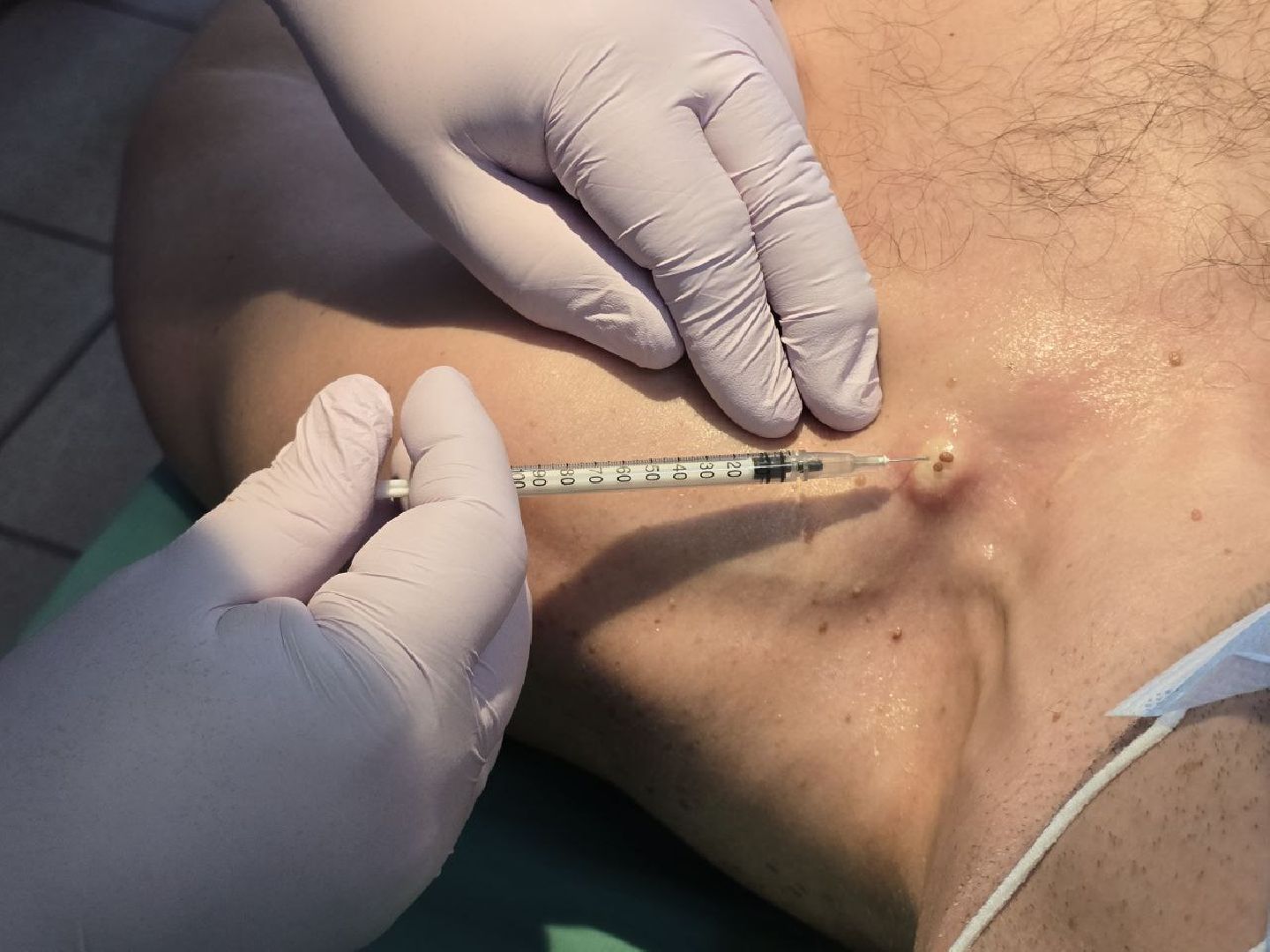 можайск, можайский муниципальный округ, подмосковье, можайская больница, медицина, здравоохранение , хирургическое отделение, новообразования кожи ,